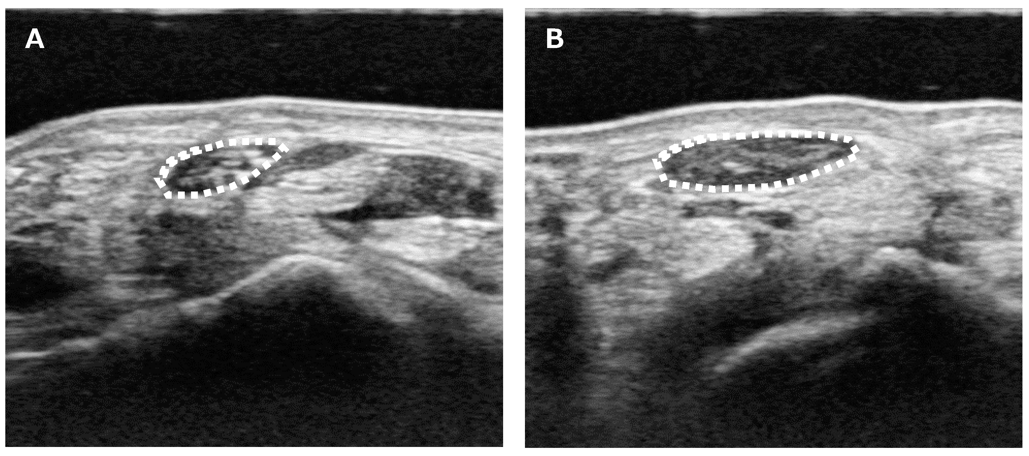 A systematic review: normative reference values of the median nerve  cross-sectional area using ultrasonography in healthy individuals