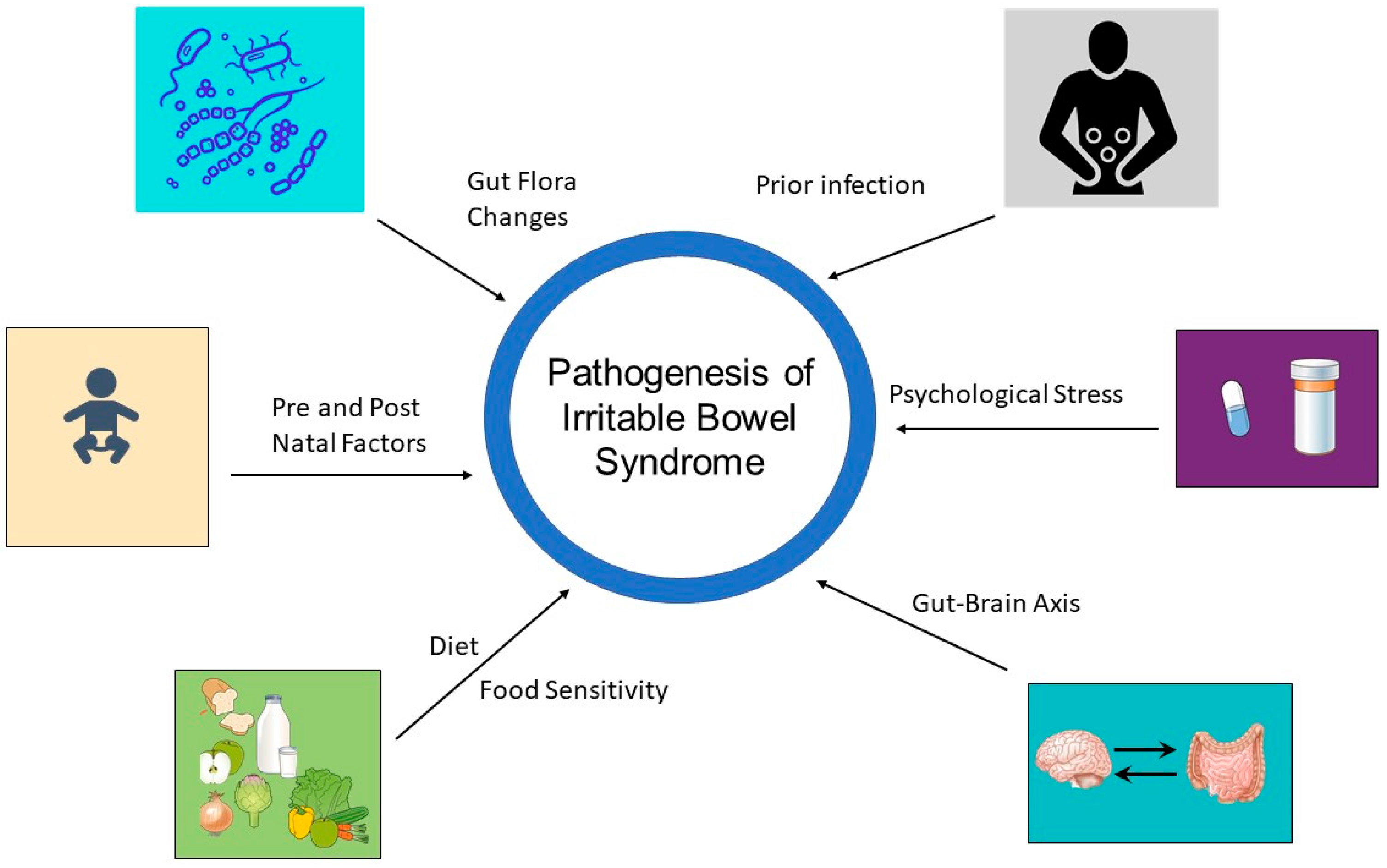 irritable bowel syndrome diagram