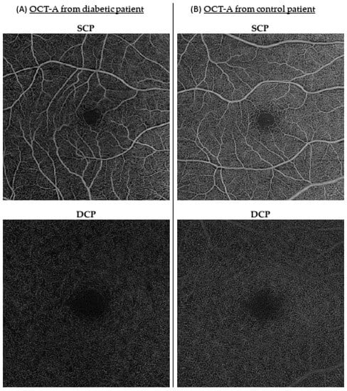 Altered ocular microvasculature in patients with systemic sclerosis and  very early disease of systemic sclerosis using optical coherence tomography  angiography