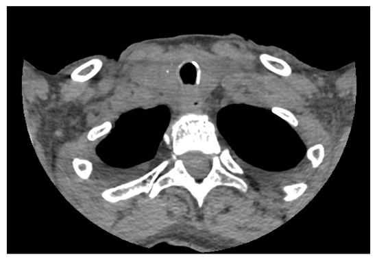 JCM | Free Full-Text | Thyroid Metastasis from Primary Breast Cancer