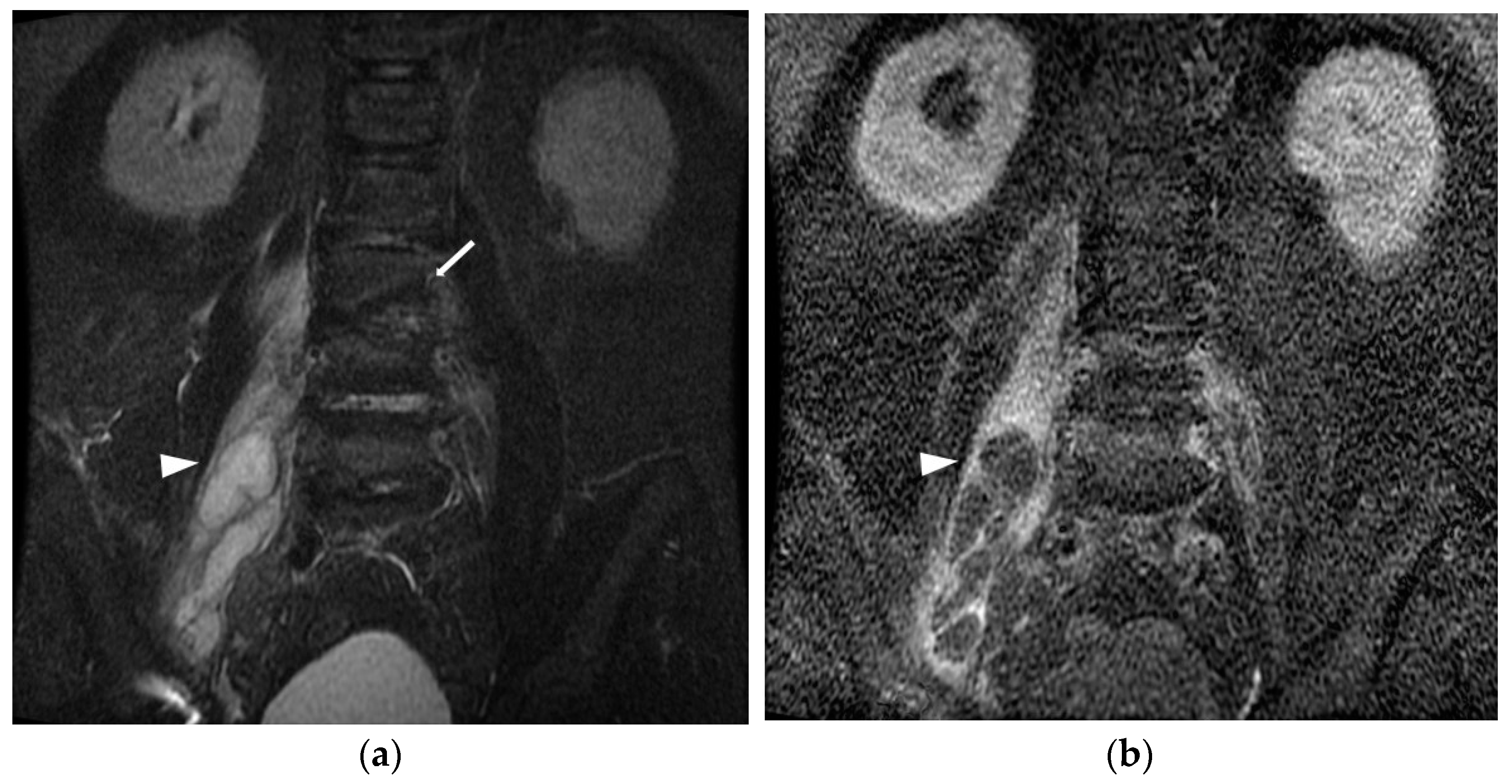 Psoas Abscess