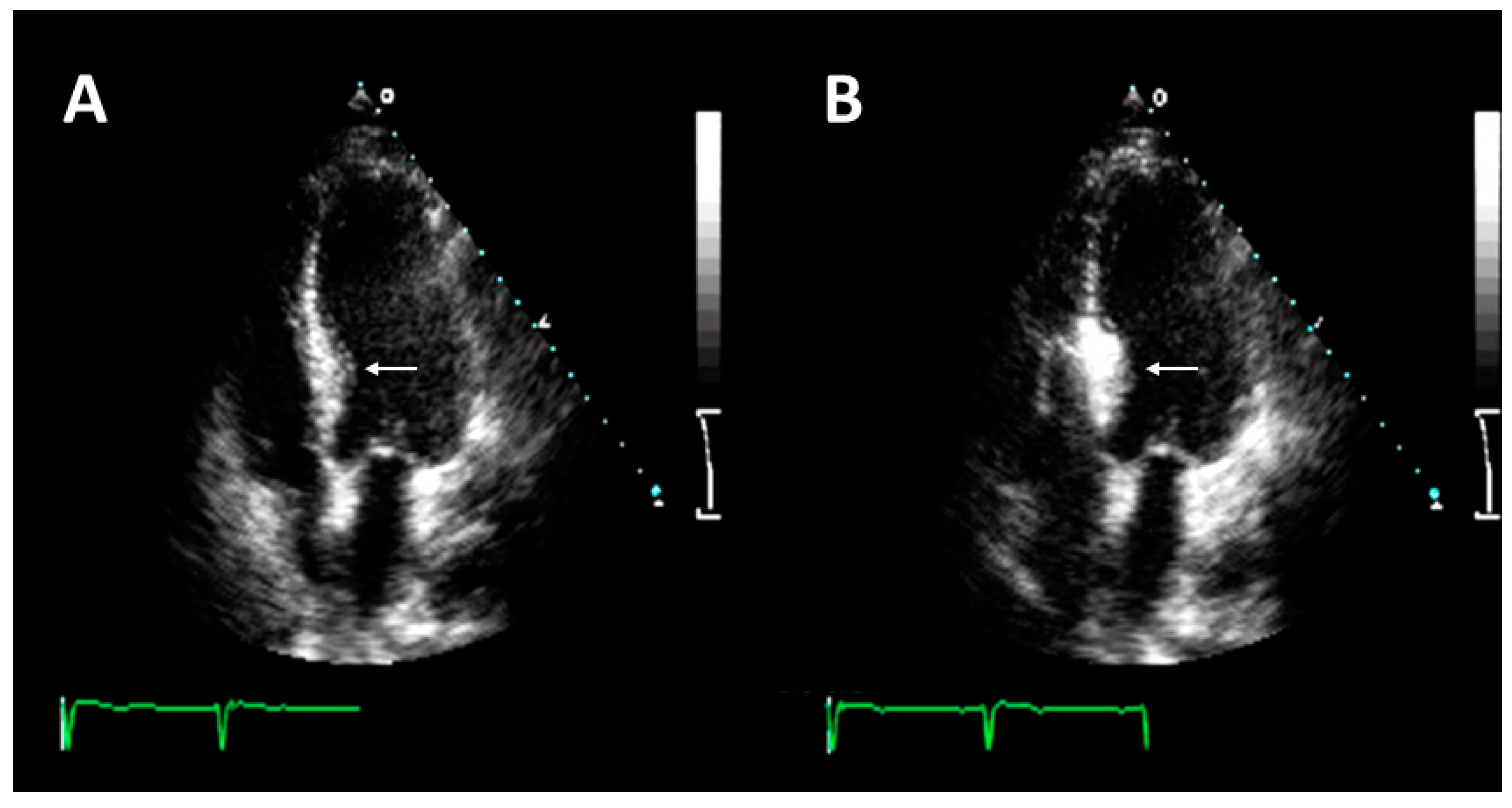 Jcm Free Full Text Alcohol Septal Ablation In Patients With