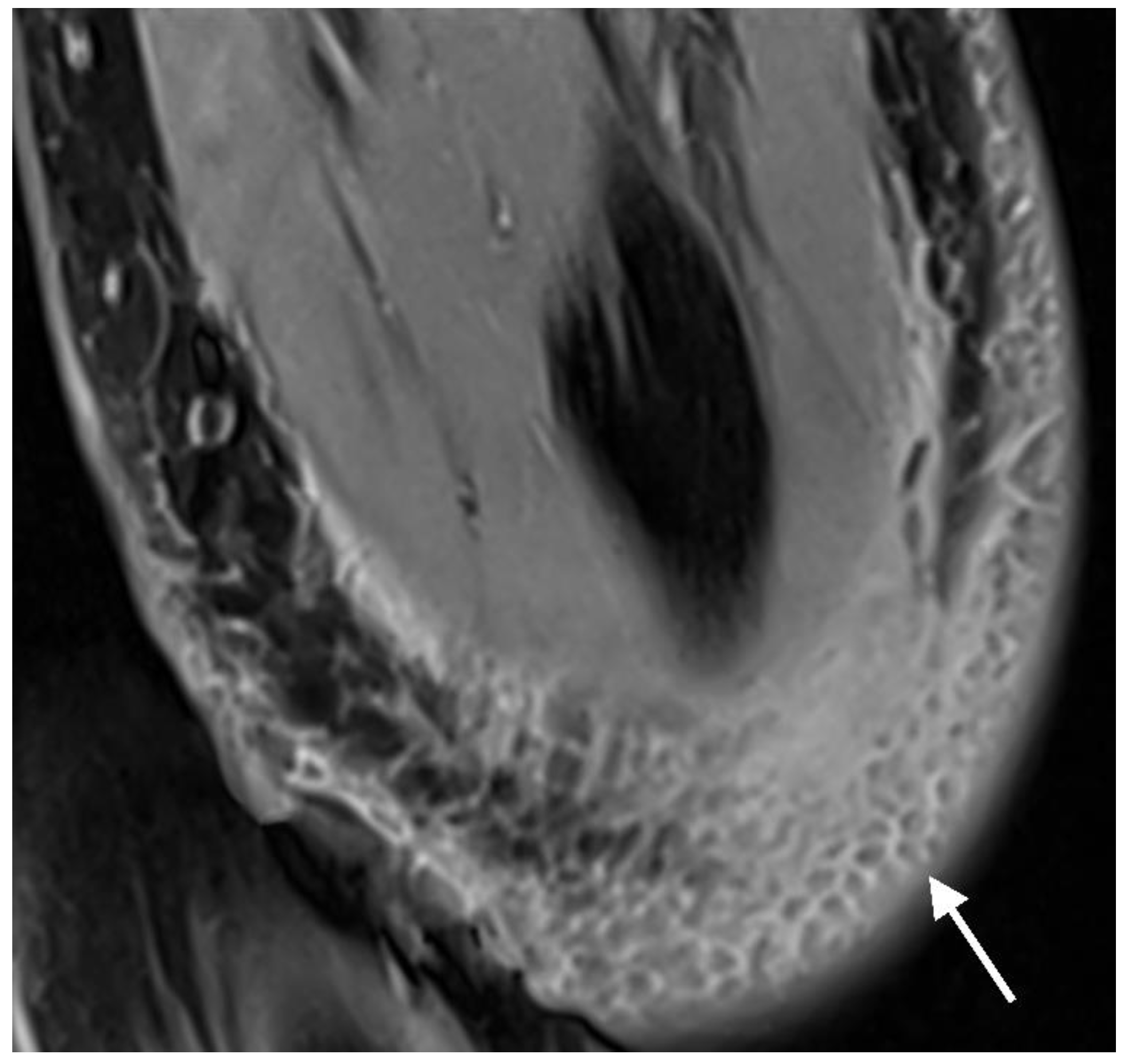 Jcm Free Full Text Prospective Evaluation Of Magnetic Resonance Imaging Features Of 