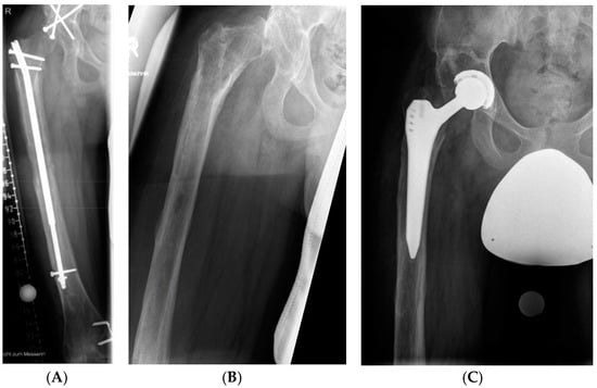 JCM | Free Full-Text | Antegrade Intramedullary Femoral Lengthening And ...