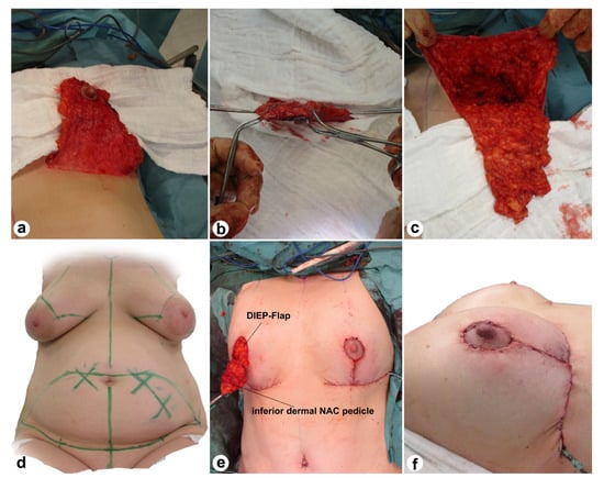 Bilateral Autologous Breast Reconstruction in a Patient with Unilateral  Breast Cancer: A Case Report.