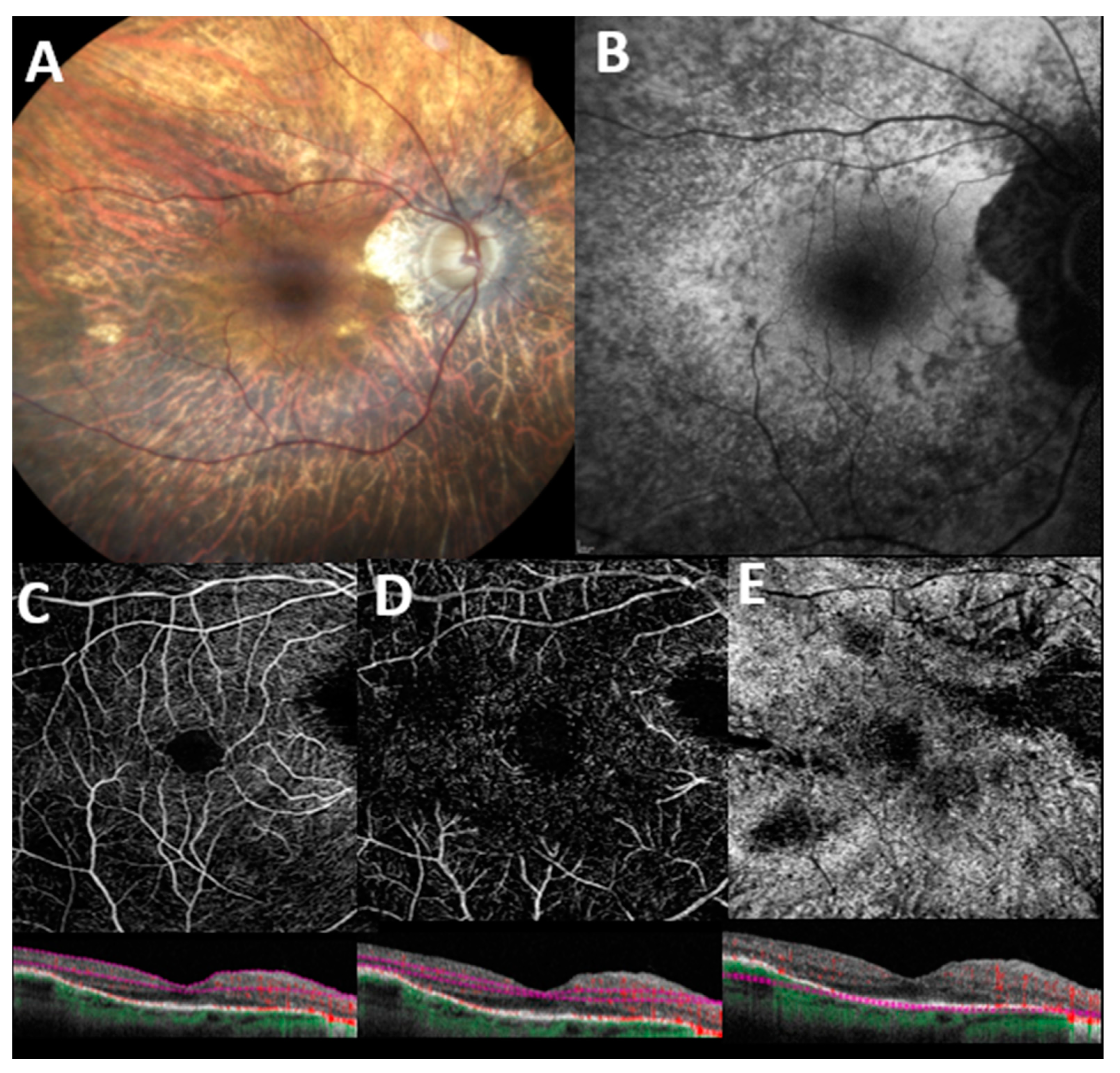 Altered ocular microvasculature in patients with systemic sclerosis and  very early disease of systemic sclerosis using optical coherence tomography  angiography