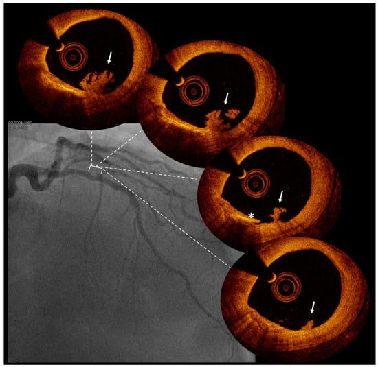 JCM | Free Full-Text | Current Role Of Intracoronary Imaging For ...