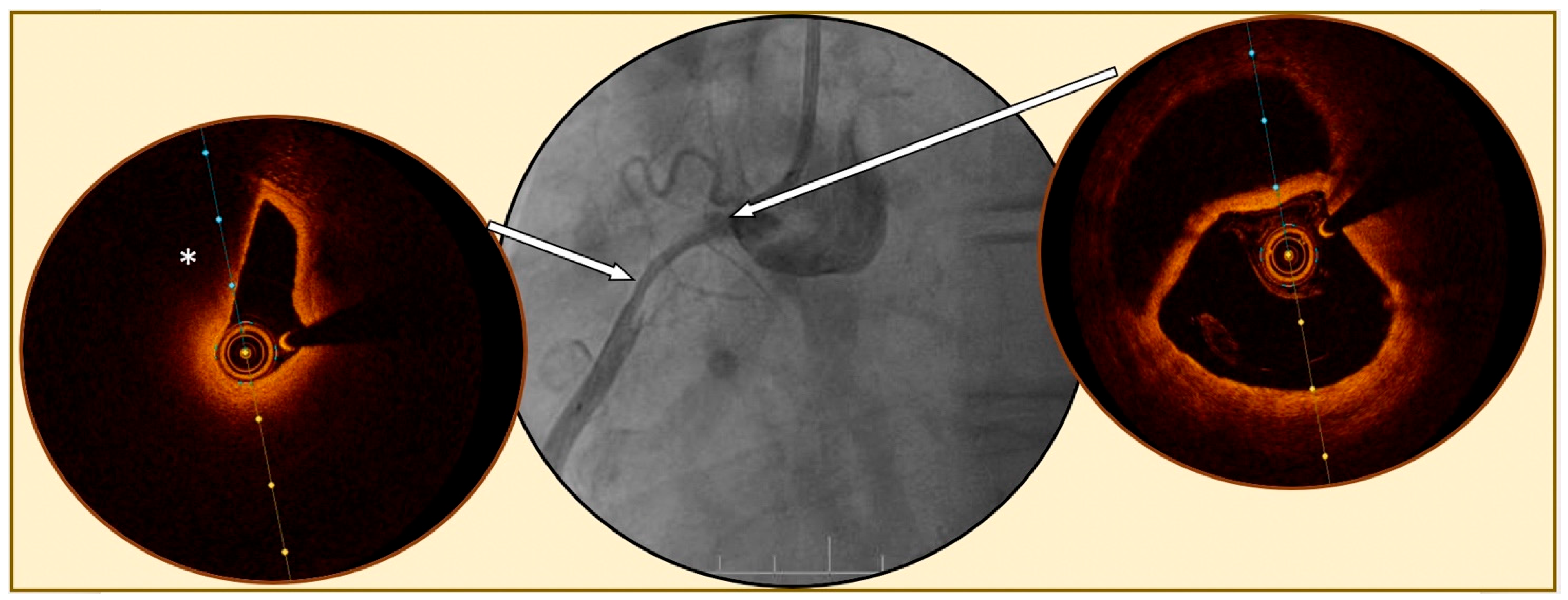 Jcm Free Full Text Current Role Of Intracoronary Imaging For Implementing Risk