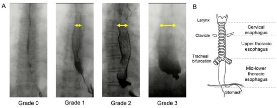 PDF) Oropharyngeal dysphagia in patients with multiple sclerosis: Do the  disease classification scales reflect dysphagia severity?