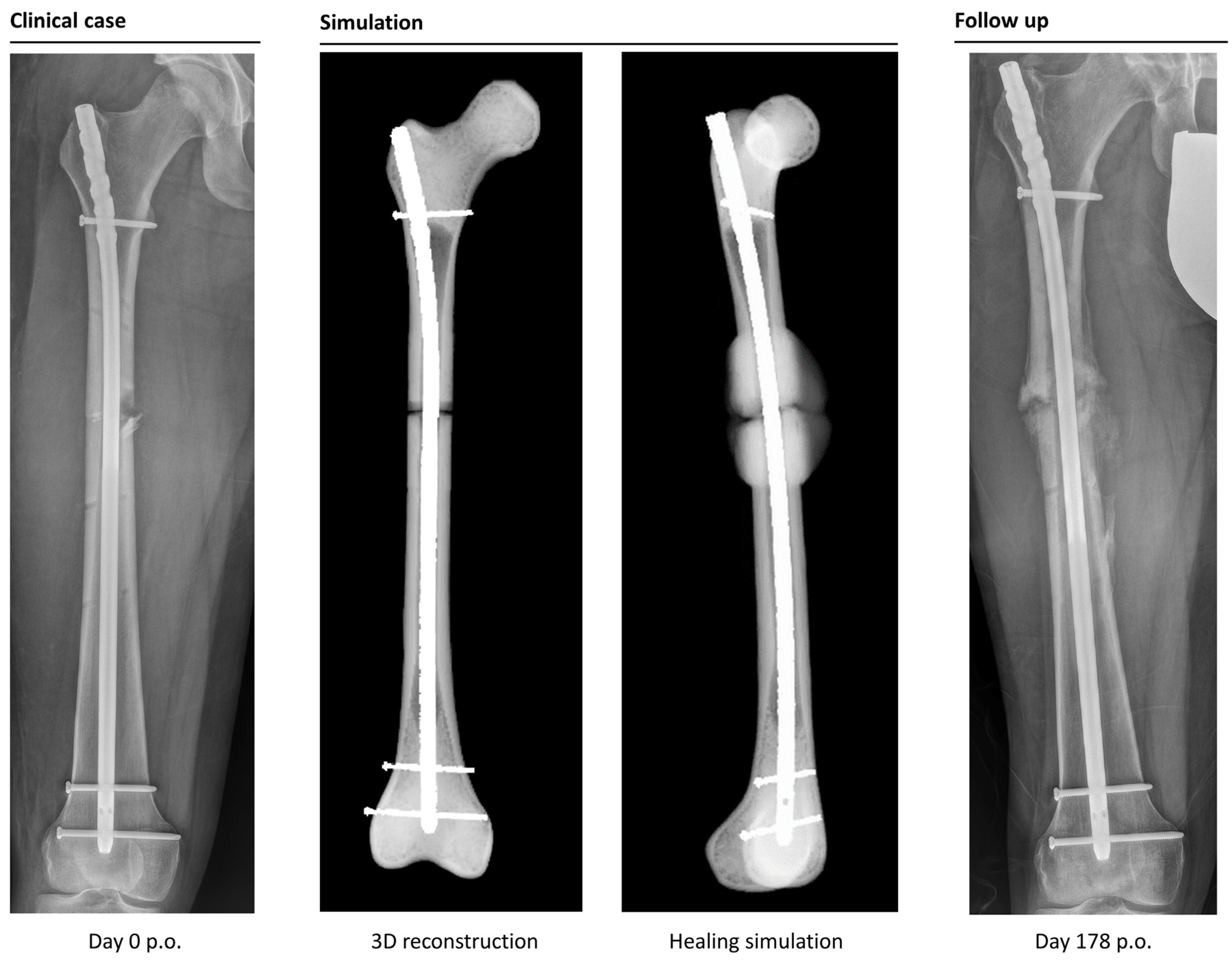 PDF) Effectiveness of Nail Dynamization in Delayed Union of Tibial Shaft  Fractures: Relationship Between Fracture Morphology, Callus Diameter, and  Union Rates | German Garabano - Academia.edu