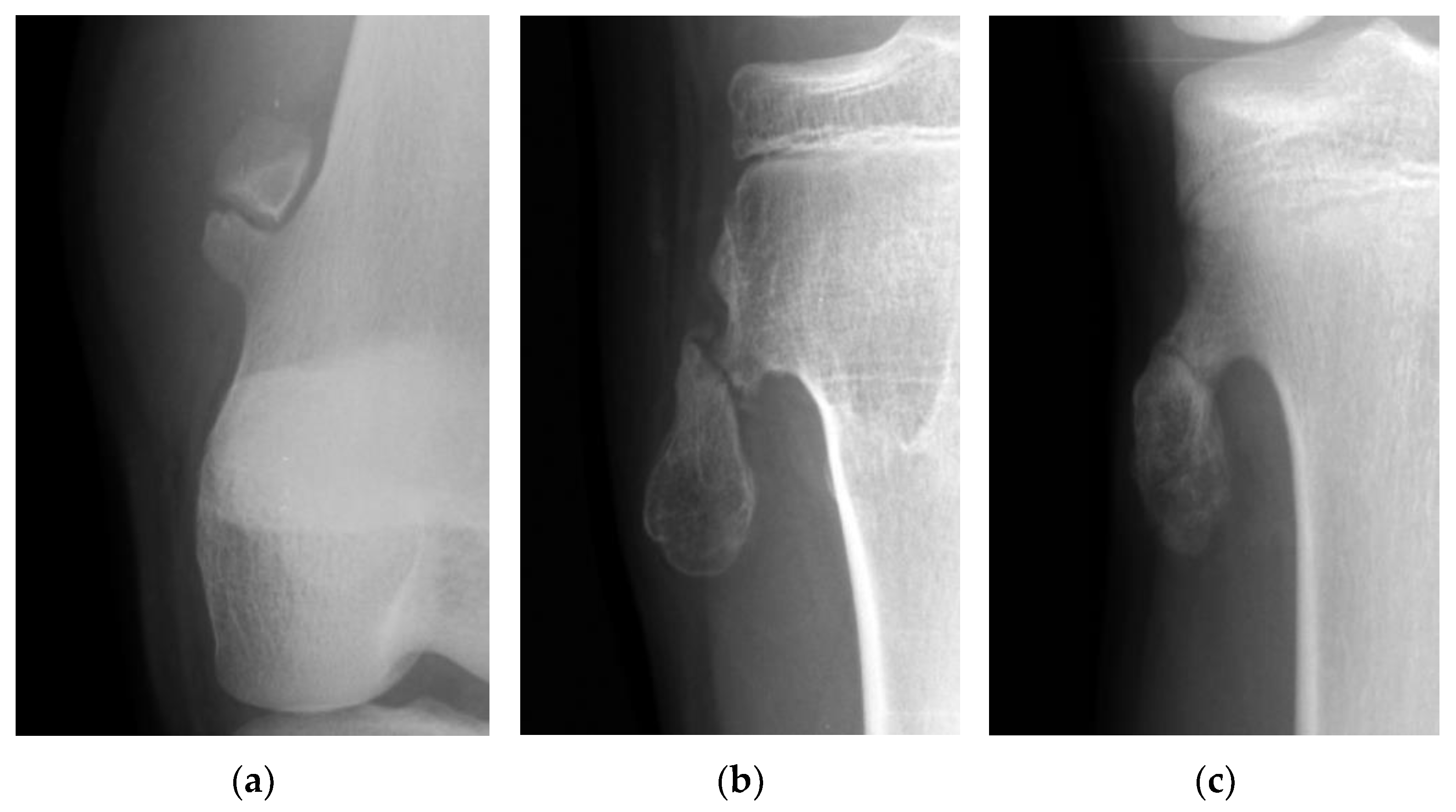 JCM | Free Full-Text | Treatment Strategy of Fractured Osteochondroma in  the Young Athlete&rsquo;s Knee