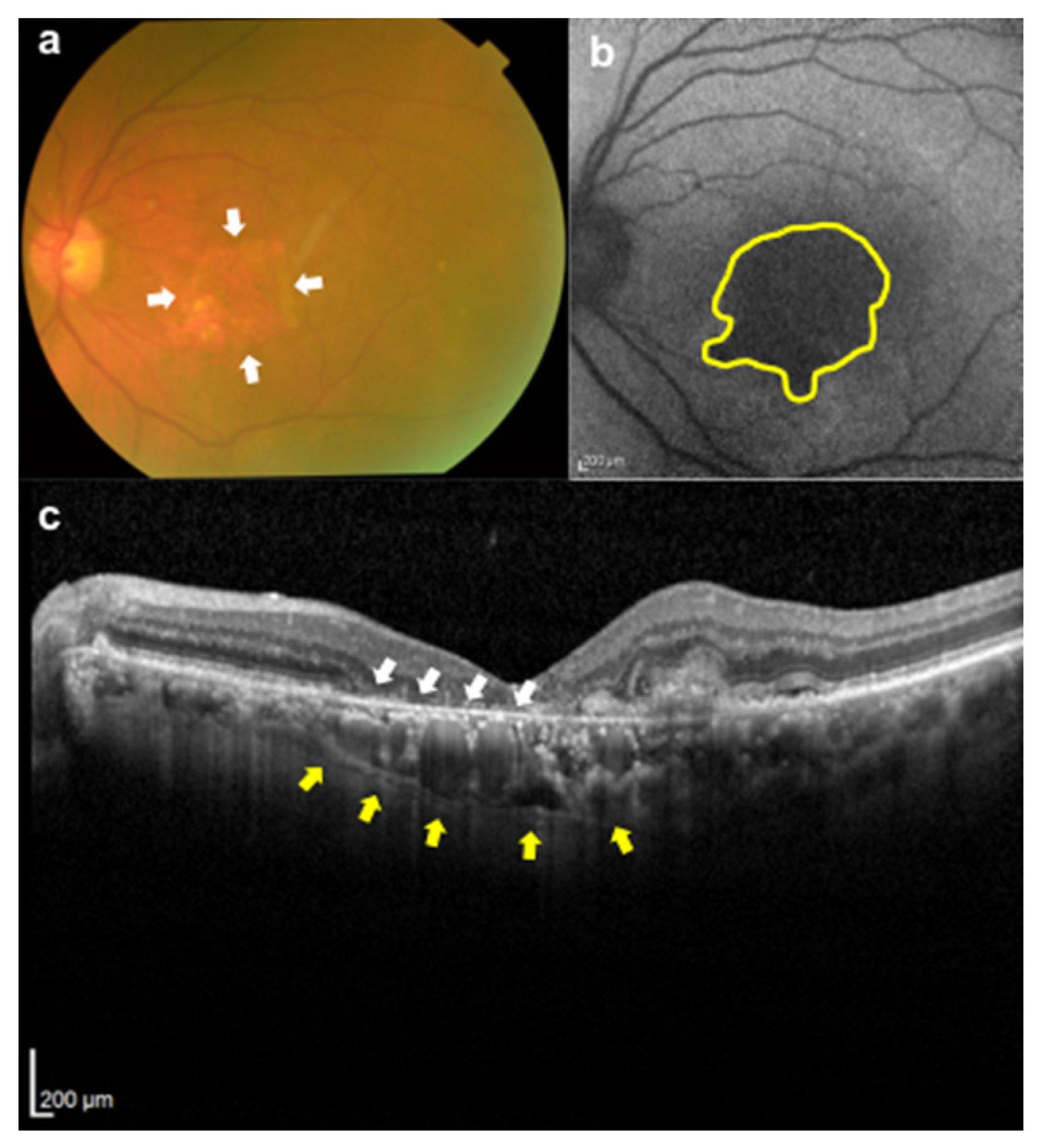 RPE Tear After Anti-VEGF Injection - Retina Image Bank