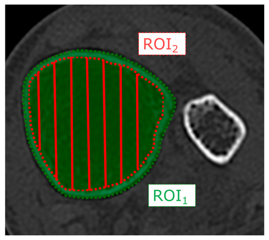 JCM | Free Full-Text | Use of Distal Tibial Cortical Bone Thickness and ...