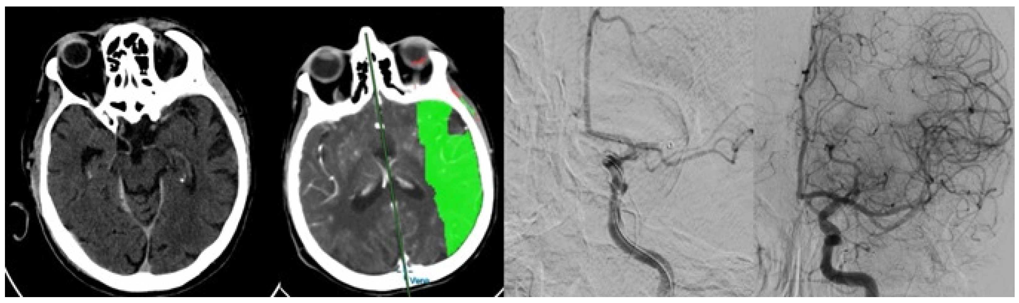 Mechanical Thrombectomy in Nighttime Hours: Is There a Difference