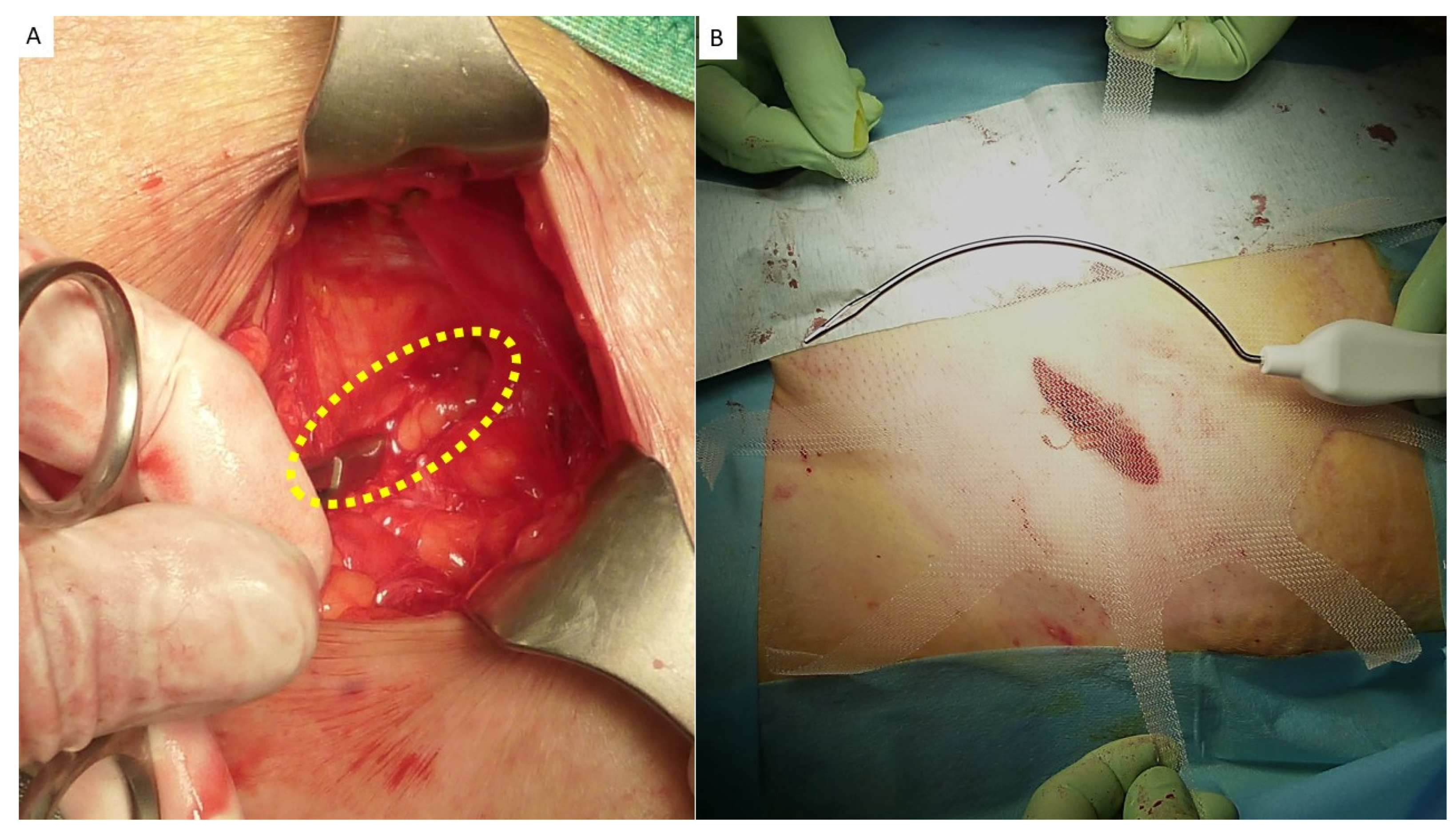 Inguinal Hernia Surgery - Treatment, Diagnosis & Repair - MH Surgery Clinic