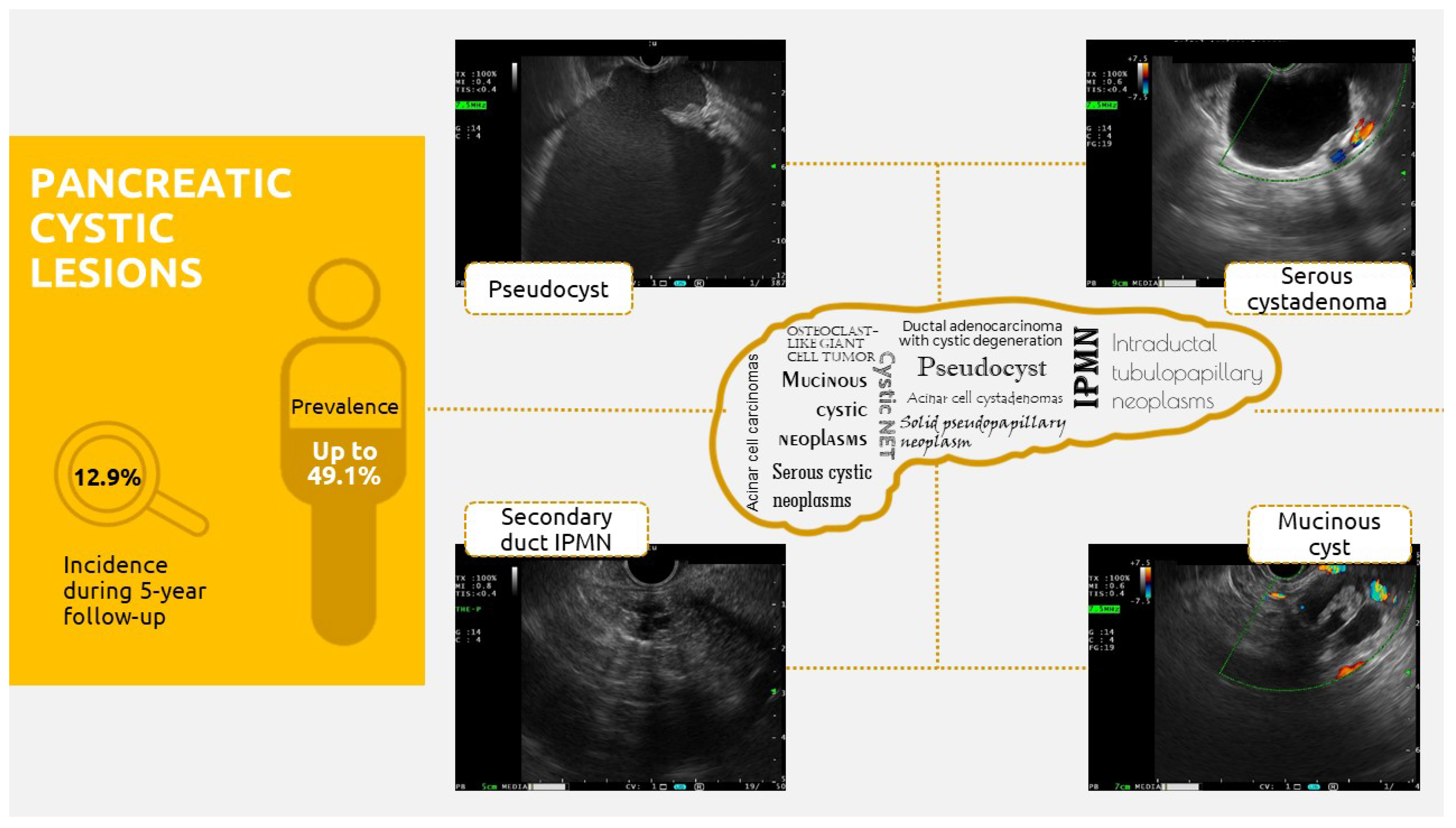 Ovarian Cystectomy: Overview, Epidemiology, Indications