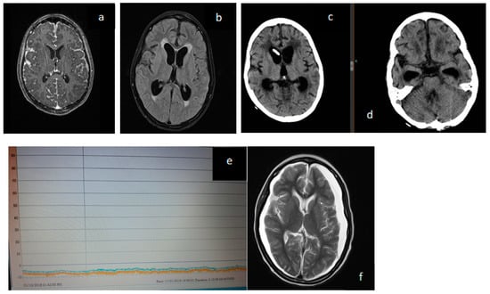 Jcm Free Full Text Low And Negative Pressure Hydrocephalus New Report Of Six Cases And 5273