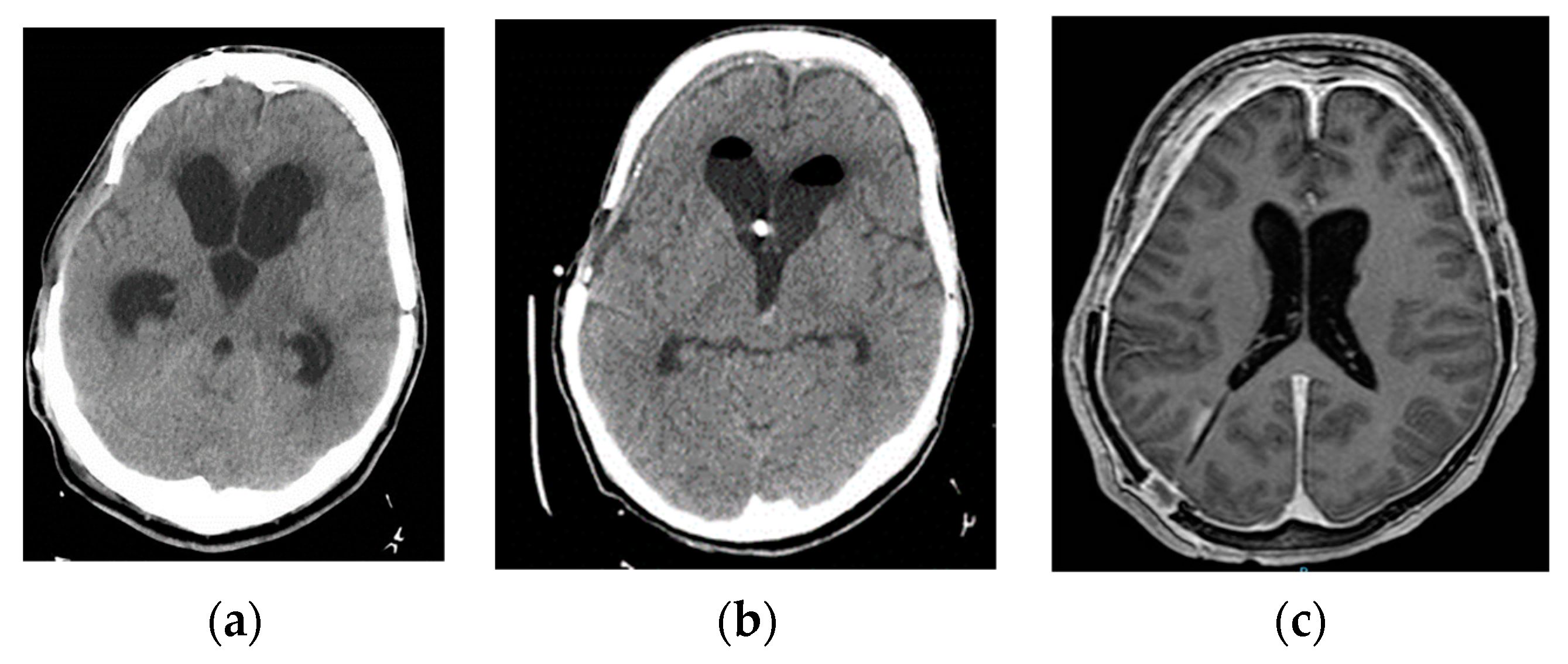 Jcm Free Full Text Low And Negative Pressure Hydrocephalus New Report Of Six Cases And 5523