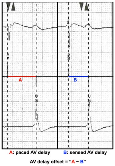 Optimization of the AV delay in a patient with complete AV block