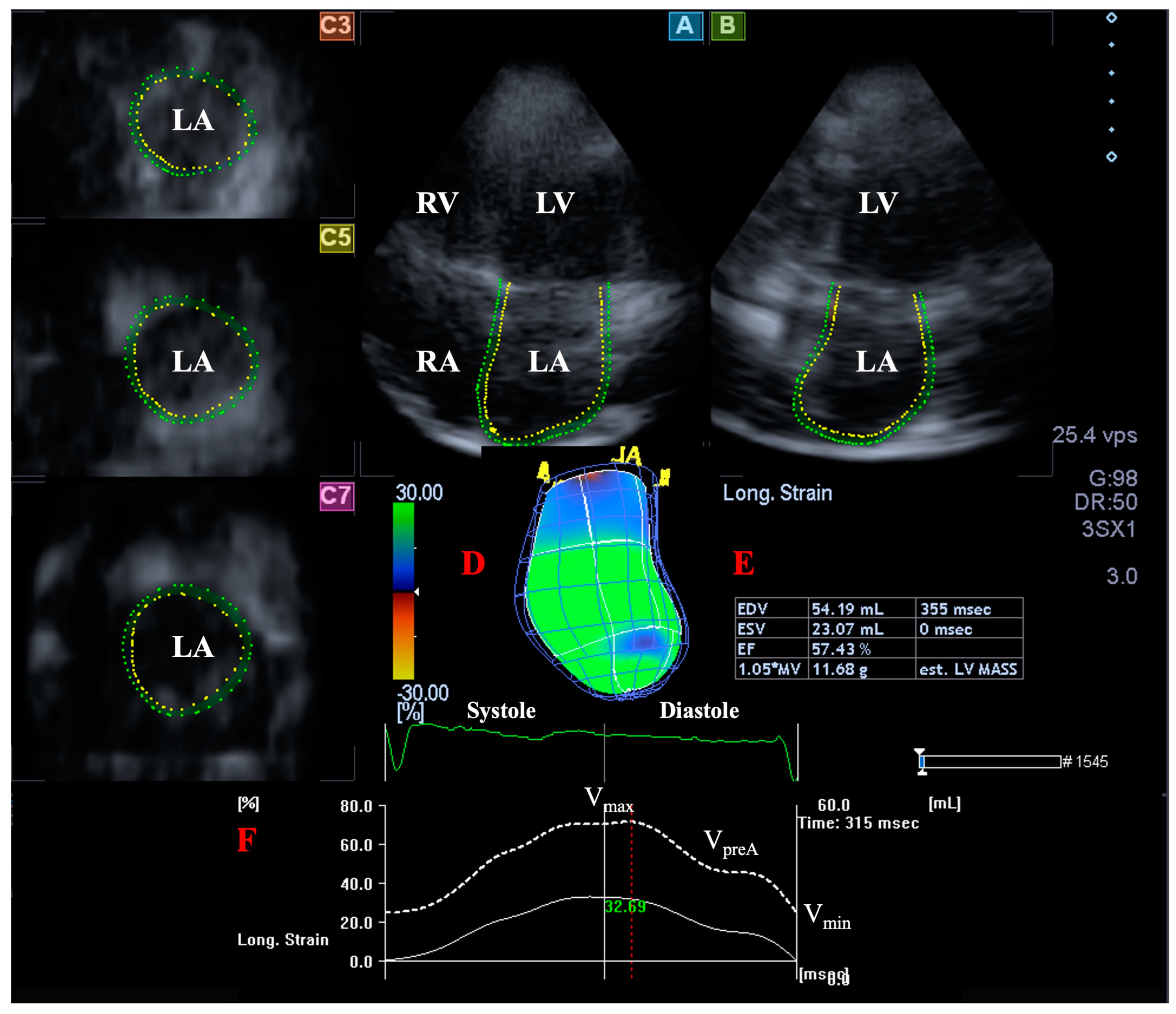 Speckle-tracking strain echocardiography: Any place in routine daily  practice in 2014?