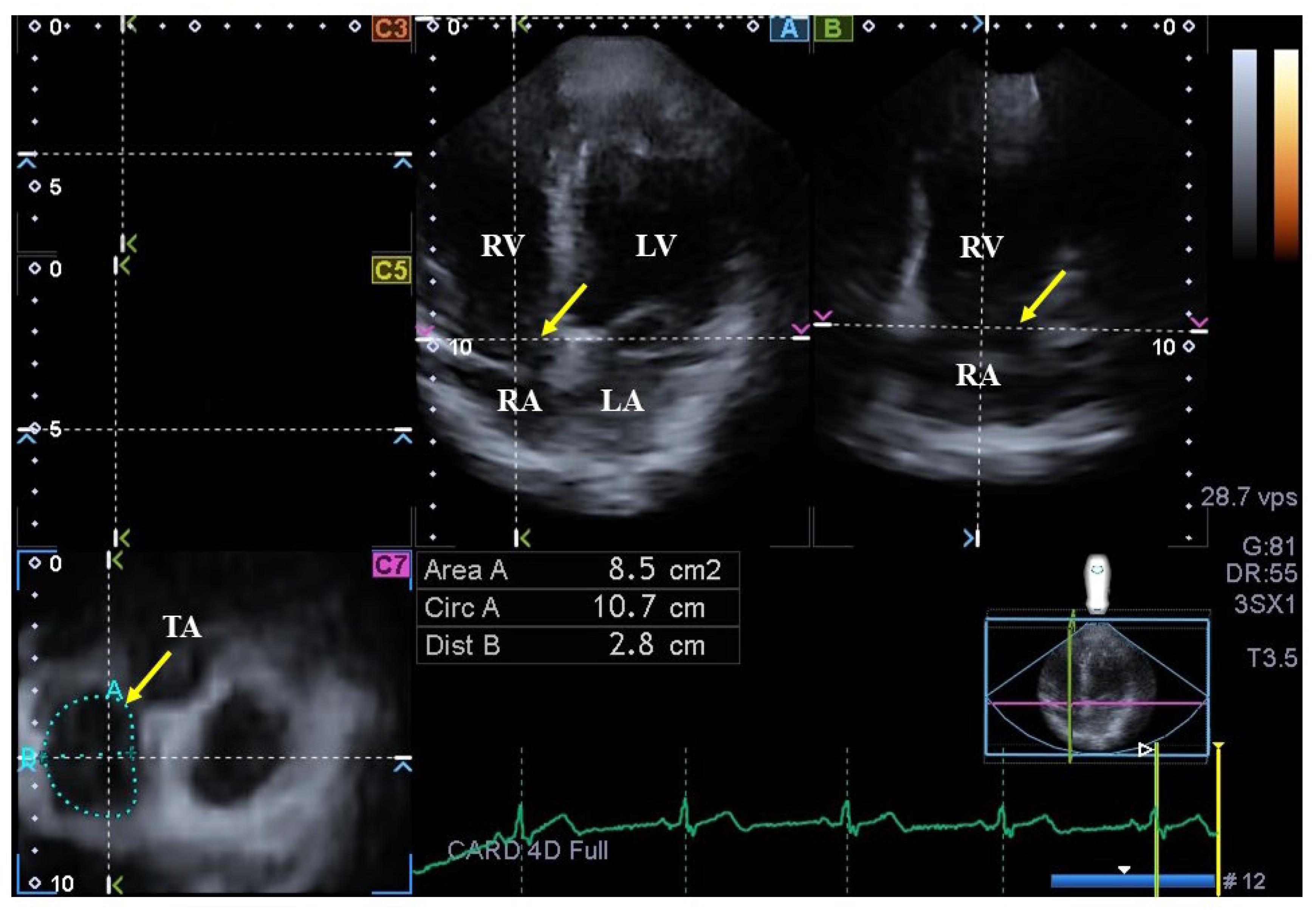 Normal reference values of right atrial strain parameters using  three-dimensional speckle-tracking echocardiography (results from the  MAGYAR-Healthy Study)