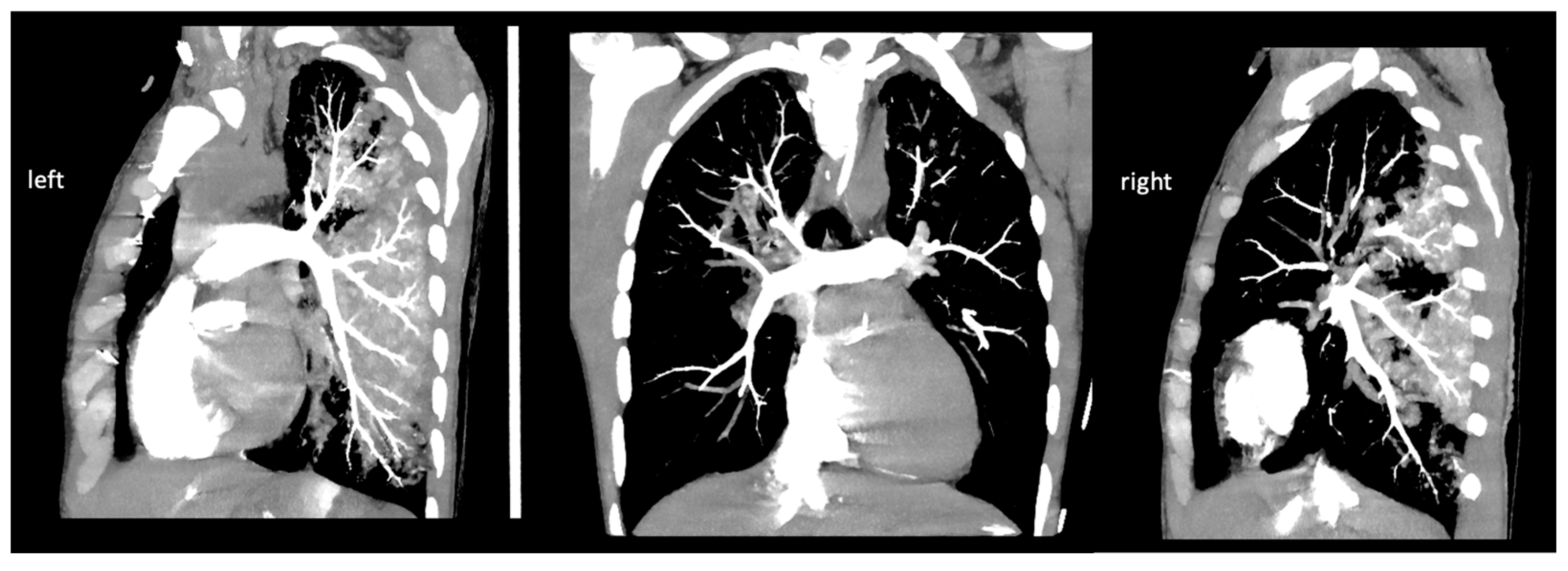 Early Application Of Ecmo After Sudden Cardiac Arrest To Prevent 