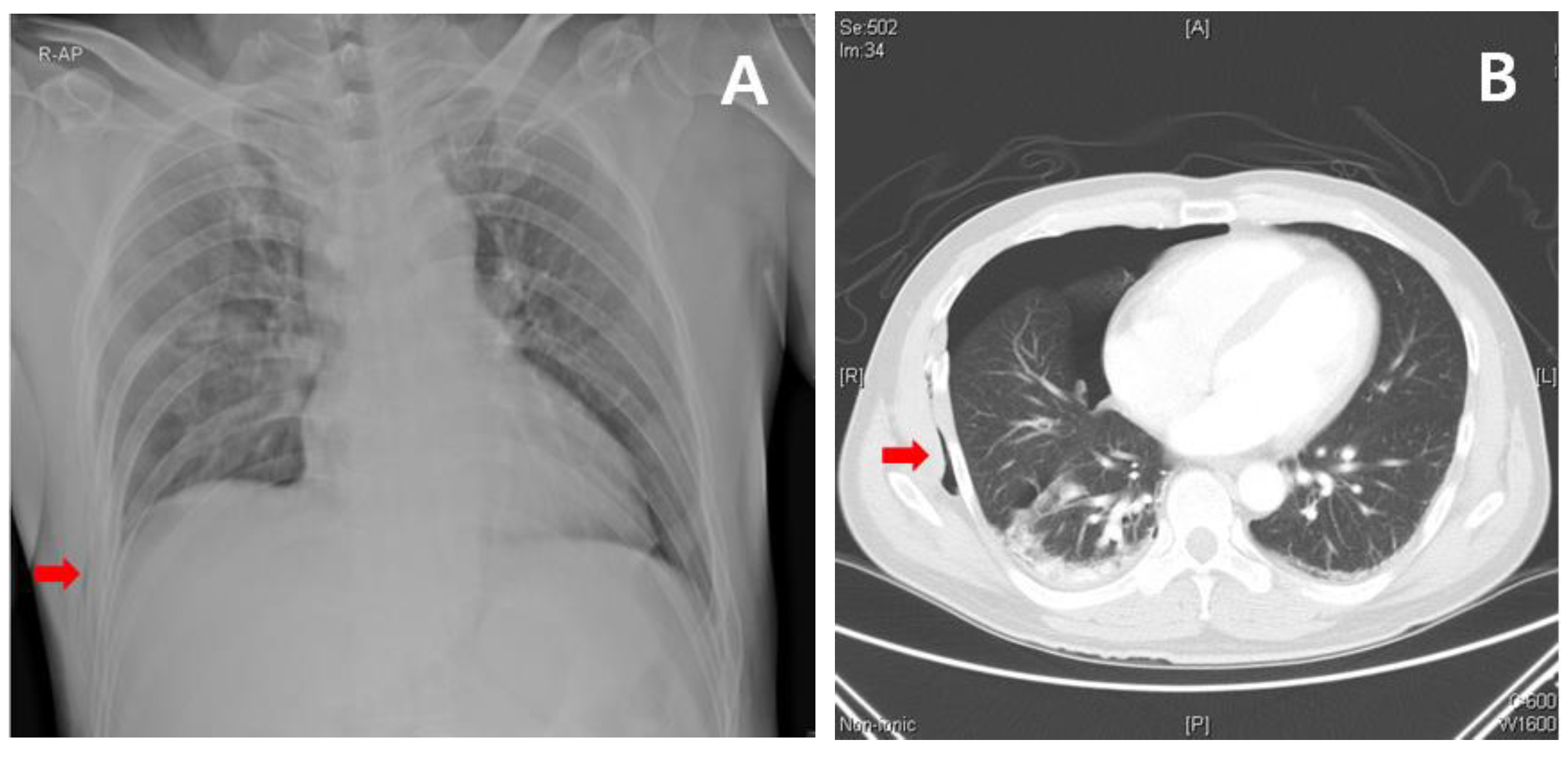 trauma pneumothorax chest tube