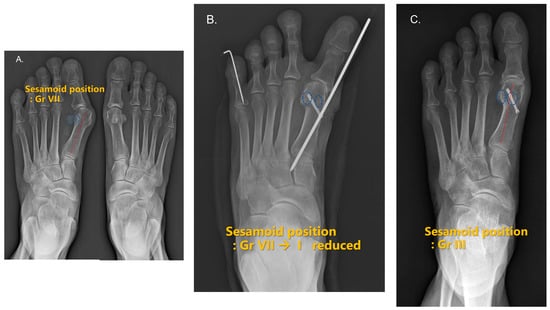 JCM | Free Full-Text | Medial Reduction in Sesamoid Position after ...