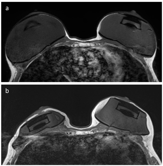 JCM | Free Full-Text | MRI-Conditional Breast Tissue Expander: First  In-Human Multi-Case Assessment of MRI-Related Complications and Image  Quality