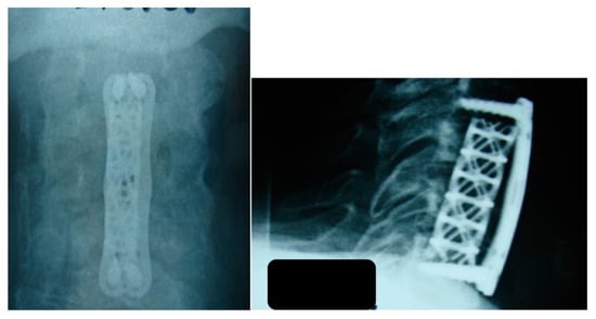 Cureus, Tuberculosis of the Cervical Spine: A Case Report