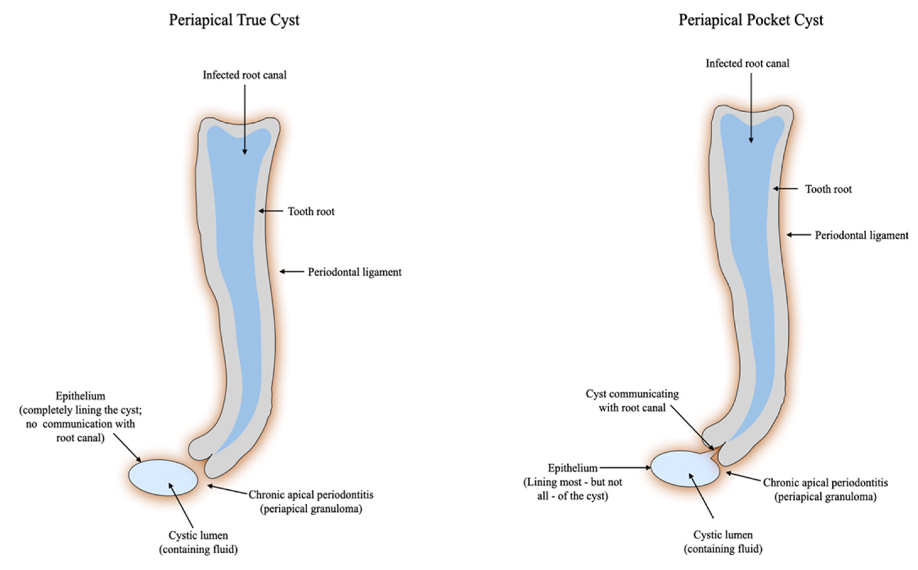 periapical granuloma vs cyst