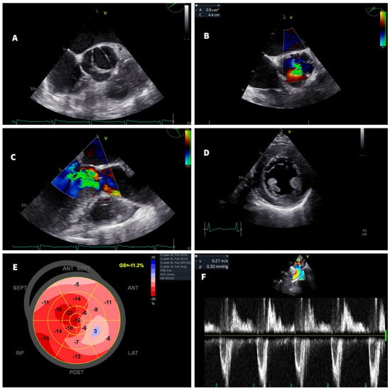 JCM | Free Full-Text | A Late-Detected Paraganglioma in a Young Patient ...