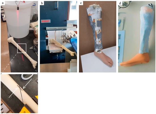 PDF] Functional Outcomes and Quality of Life Following Complex Tibial  Fractures Treated with Circular External Fixation: A Comparison between  Proximal, Midshaft, and Distal Tibial Fractures