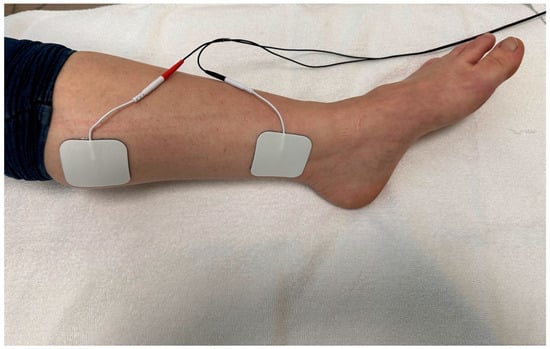 Tibial nerve stimulation using rechargeable TENS Unit : r/OveractiveBladder