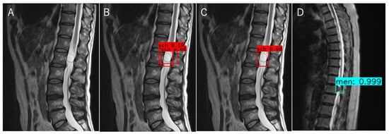 Jcm Free Full Text Automated Detection And Diagnosis Of Spinal Schwannomas And Meningiomas 