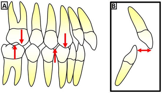 17-year-old female with Class II malocclusion and traumatic deepbite