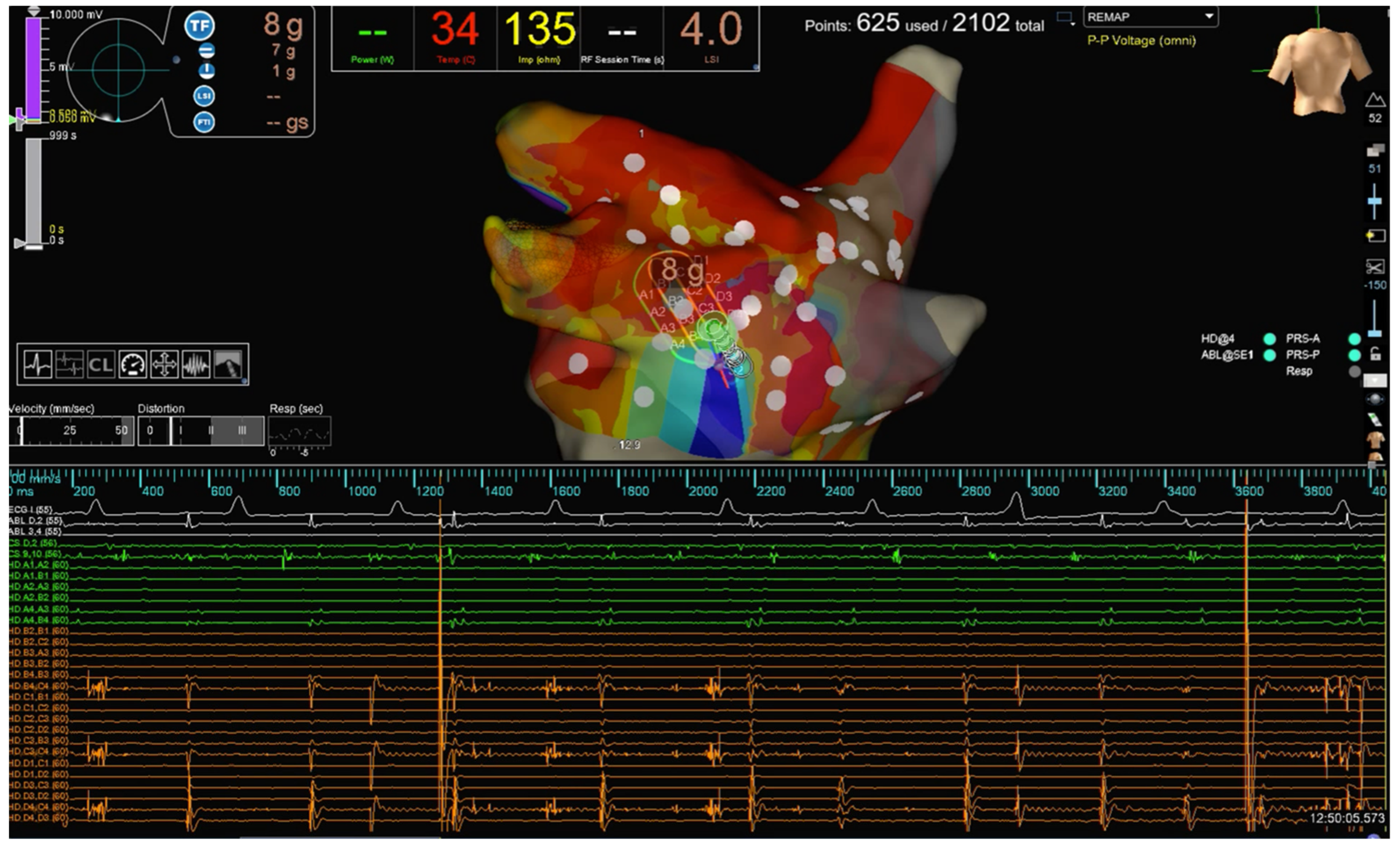 High-power, Short-duration Radiofrequency Compared with Standard  Radiofrequency Ablation