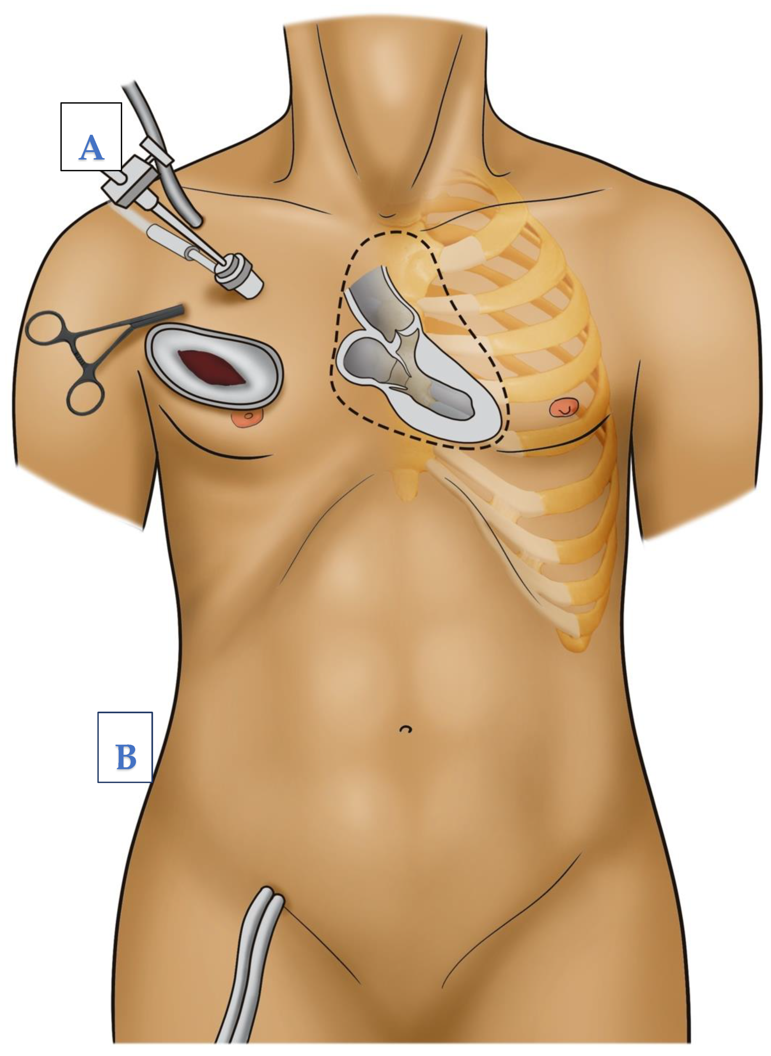 PDF) Percutaneous Venous Cannulation for Minimally Invasive Cardiac  Surgery: The Safest and Effective Technique Described Step-by-Step