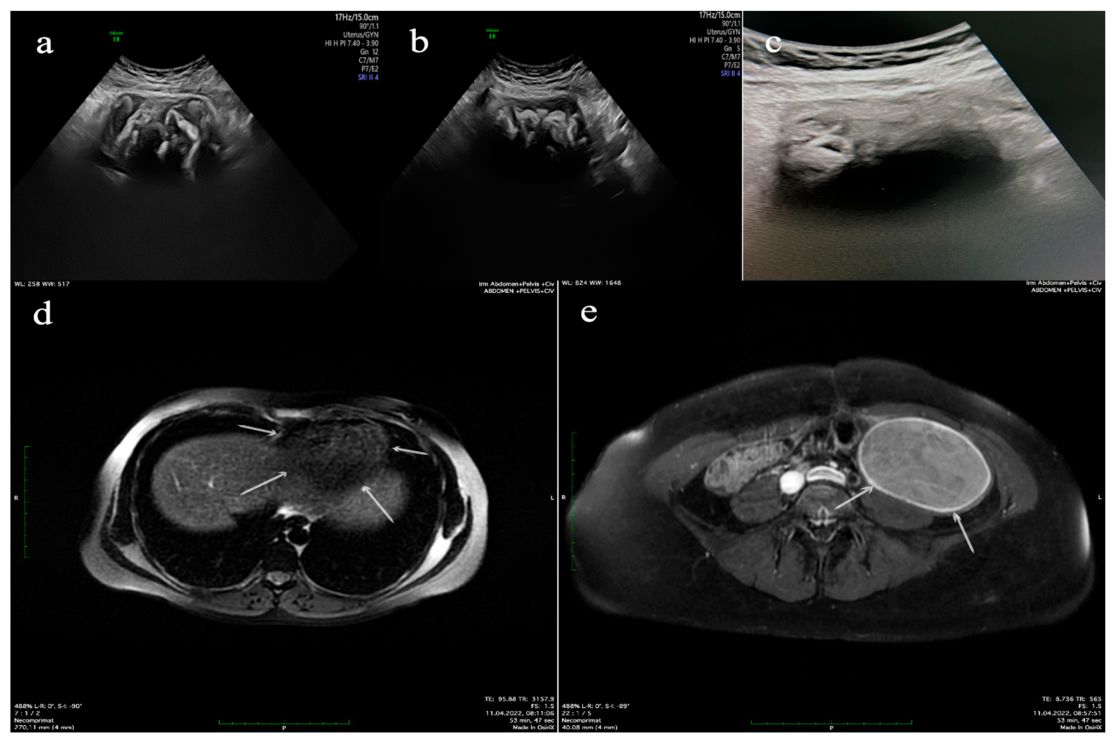 JCM | Free Full-Text | Gossypiboma, the Hidden Enemy of an Emergency  Cesarean Hysterectomy&mdash;Case Report and Review of the Literature