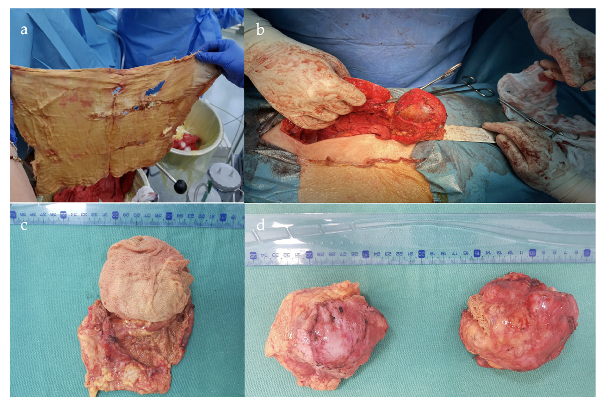 Cureus, A Case of Hemorrhagic Ovarian Cyst Rupture Necessitating Surgical  Intervention