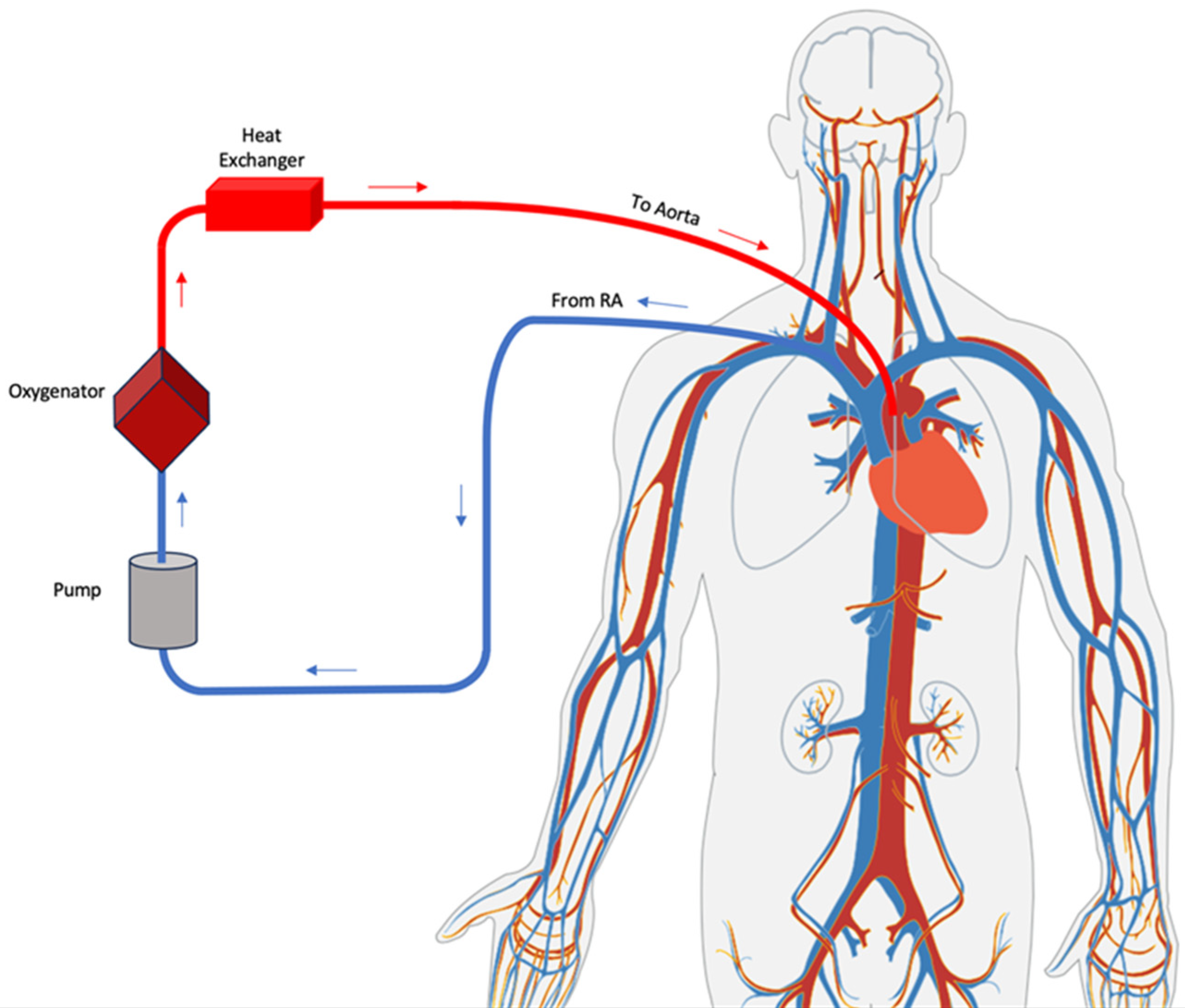 JCM | Free Full-Text | Extracorporeal Membrane Oxygenation (VA-ECMO) in  Management of Cardiogenic Shock