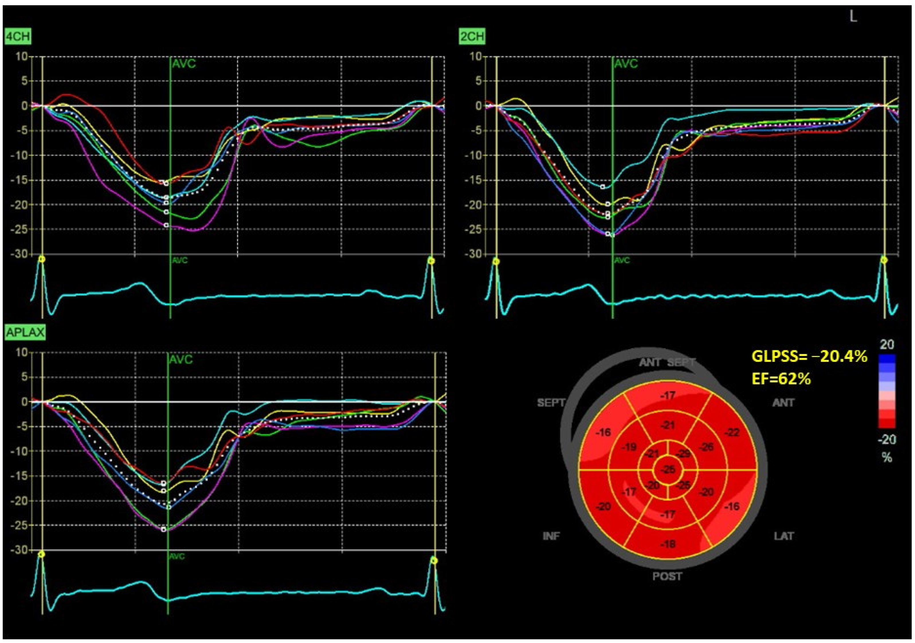 Value of peak strain dispersion in discovering left ventricular dysfunction  in diabetes mellitus