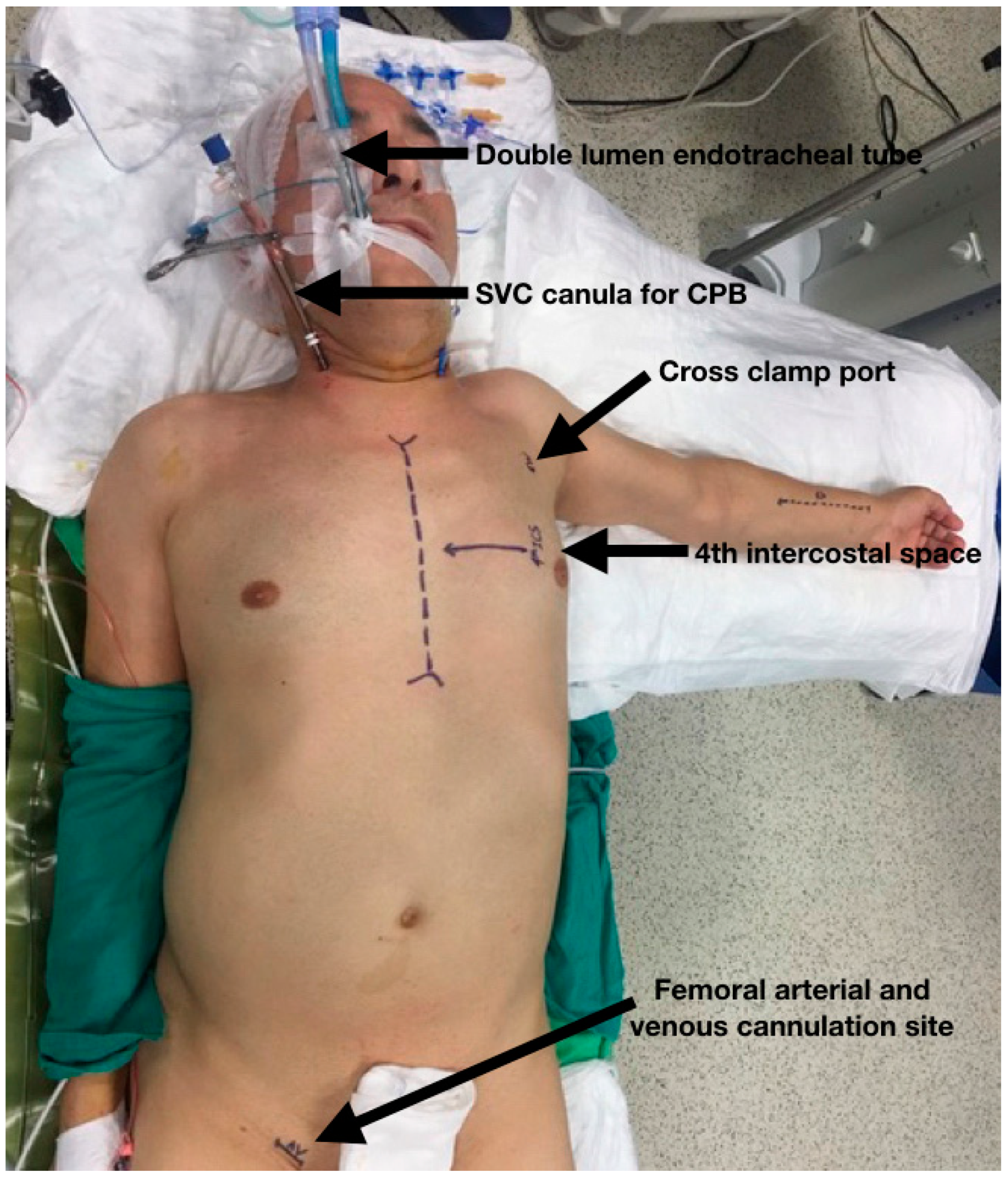 Beating-Heart, Off-Pump Coronary Artery Bypass Surgery - UChicago