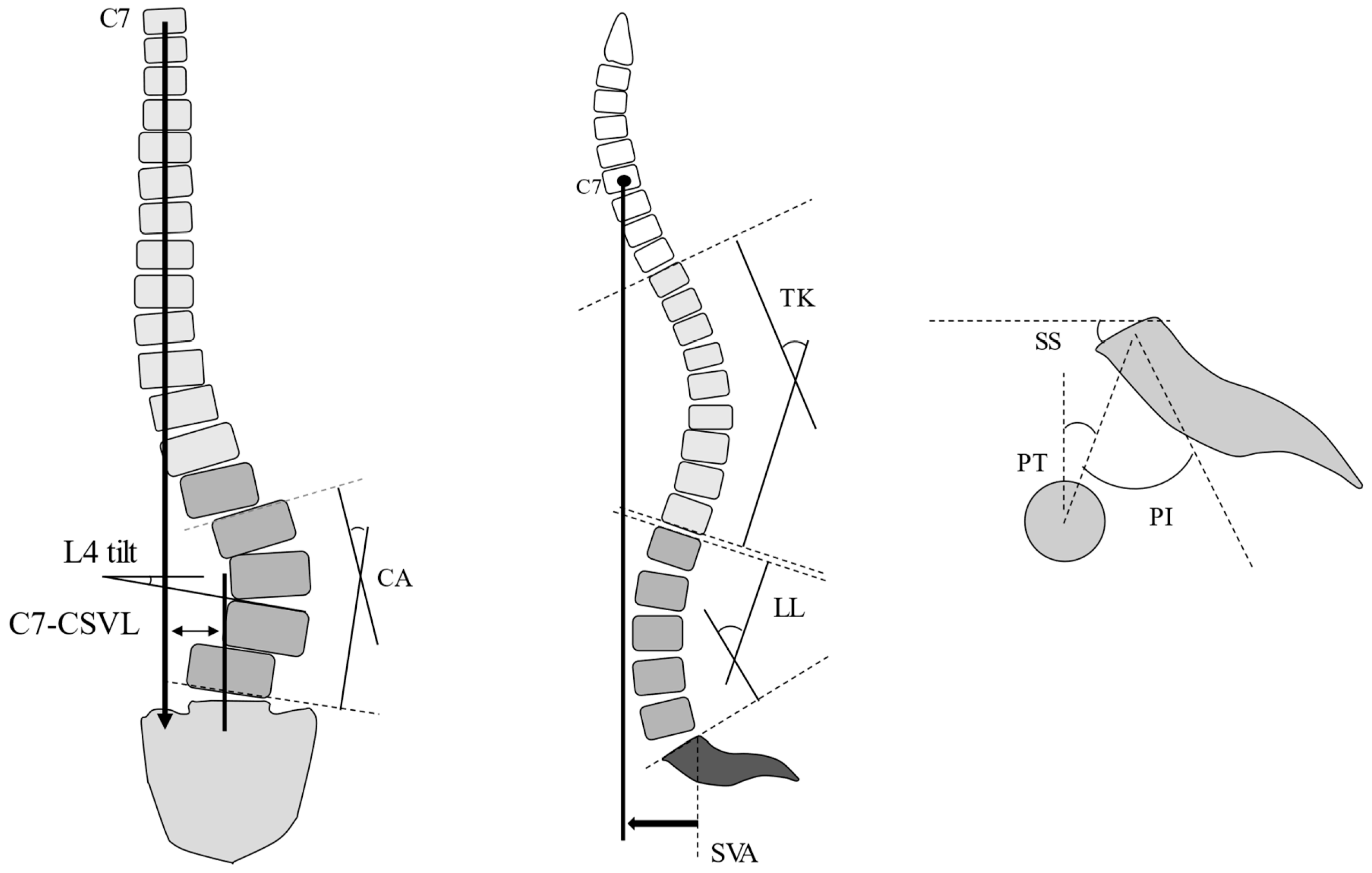 The sagittal vertical axis, corresponding to the plumb line in the