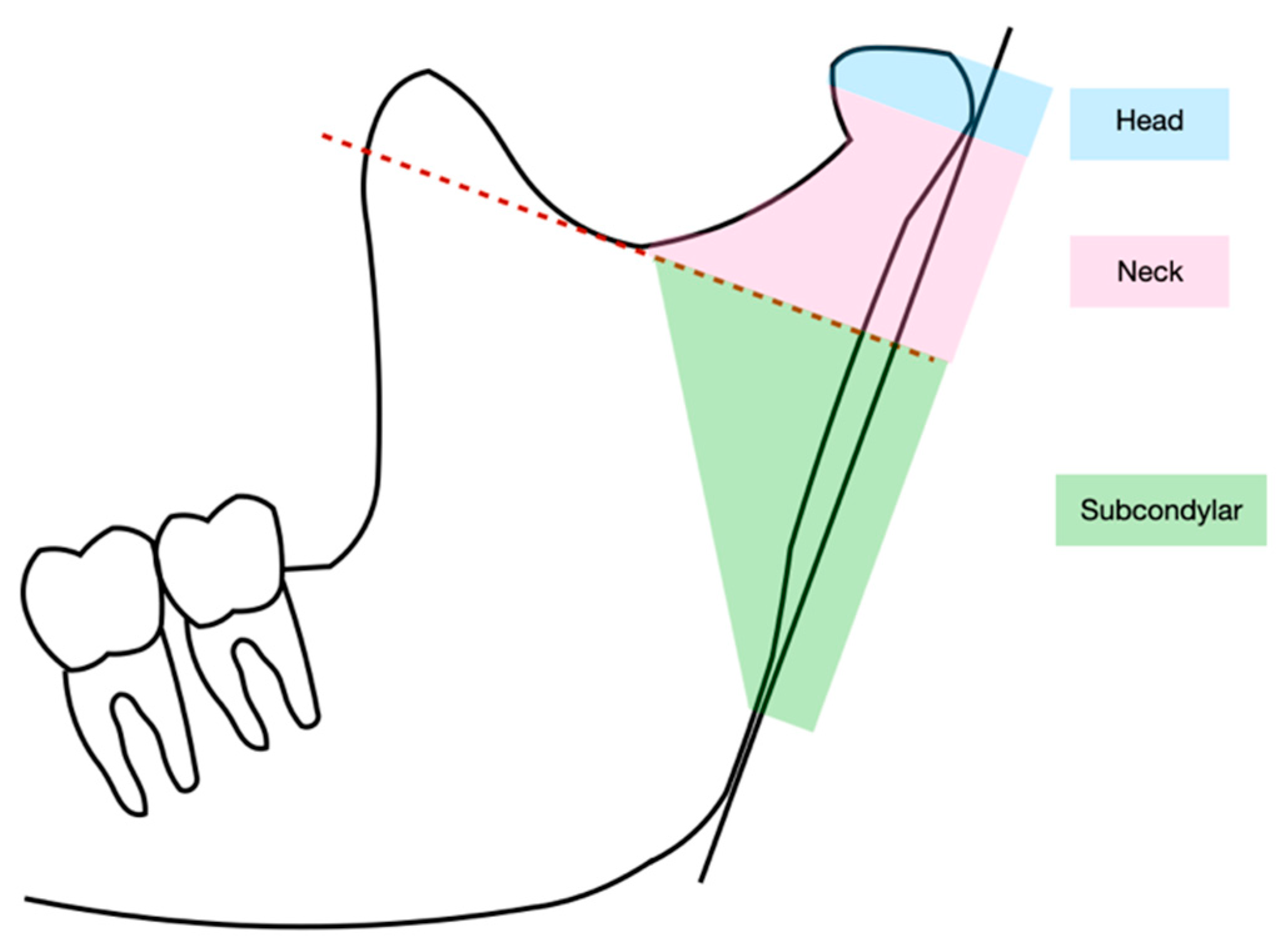 Jcm Free Full Text Analysis Of Mandibular Muscle Variations Following Condylar Fractures A 3928