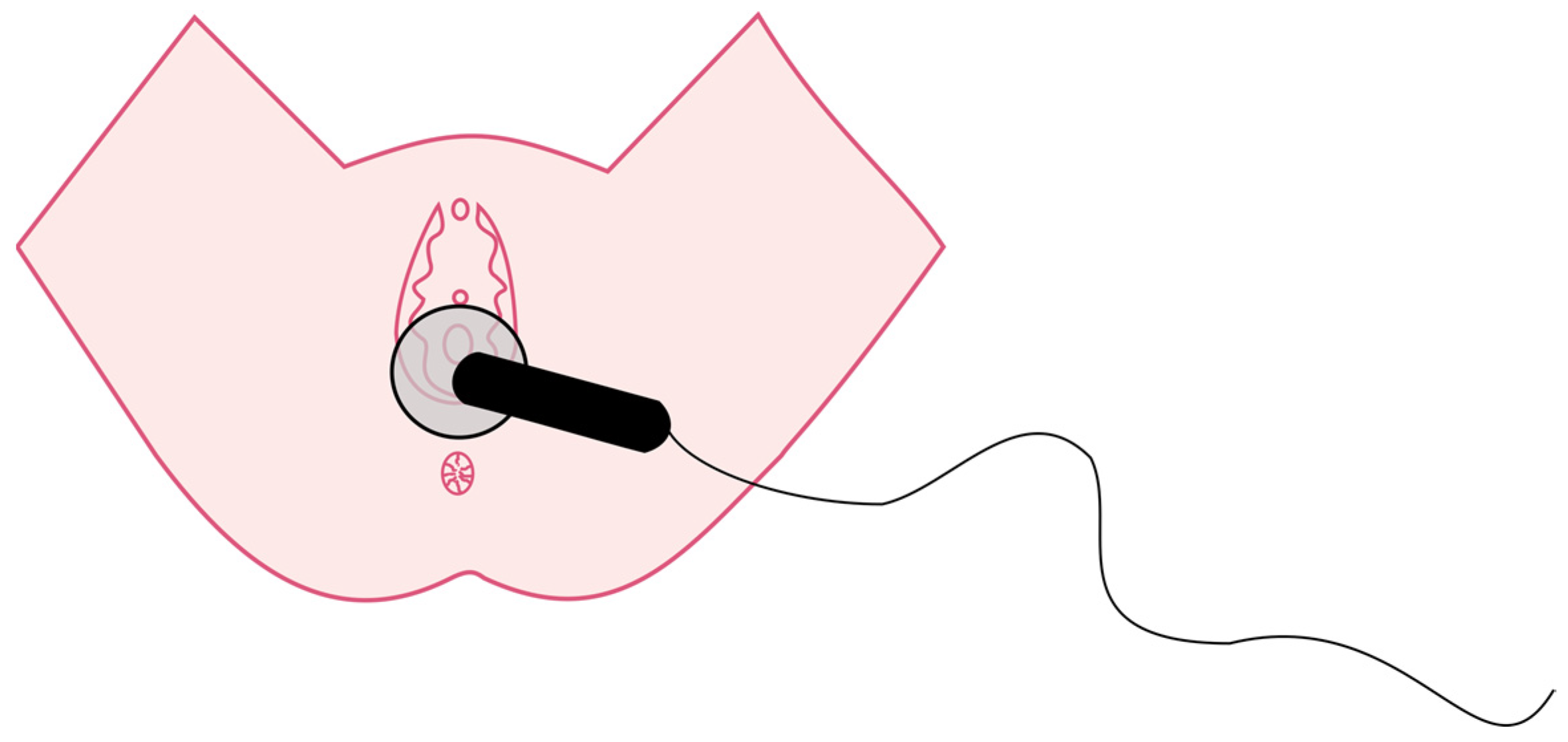 The Use of Capacitive and Resistive Energy Transfer in Postpartum