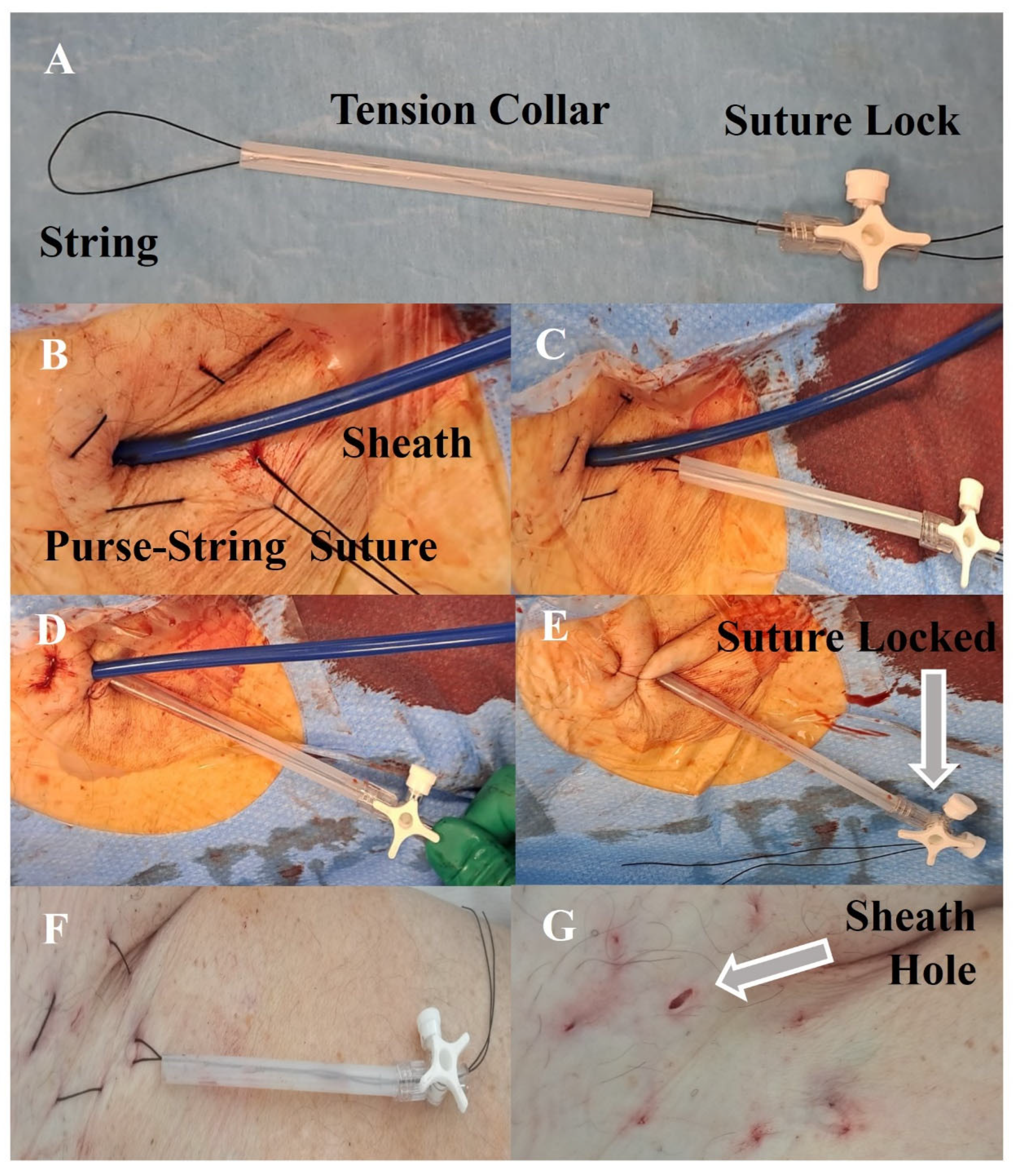 Figure 2 | Inadvertent Entrapment of a Central Venous Catheter by a Purse-String  Suture during Cardiopulmonary Bypass: A Case Report
