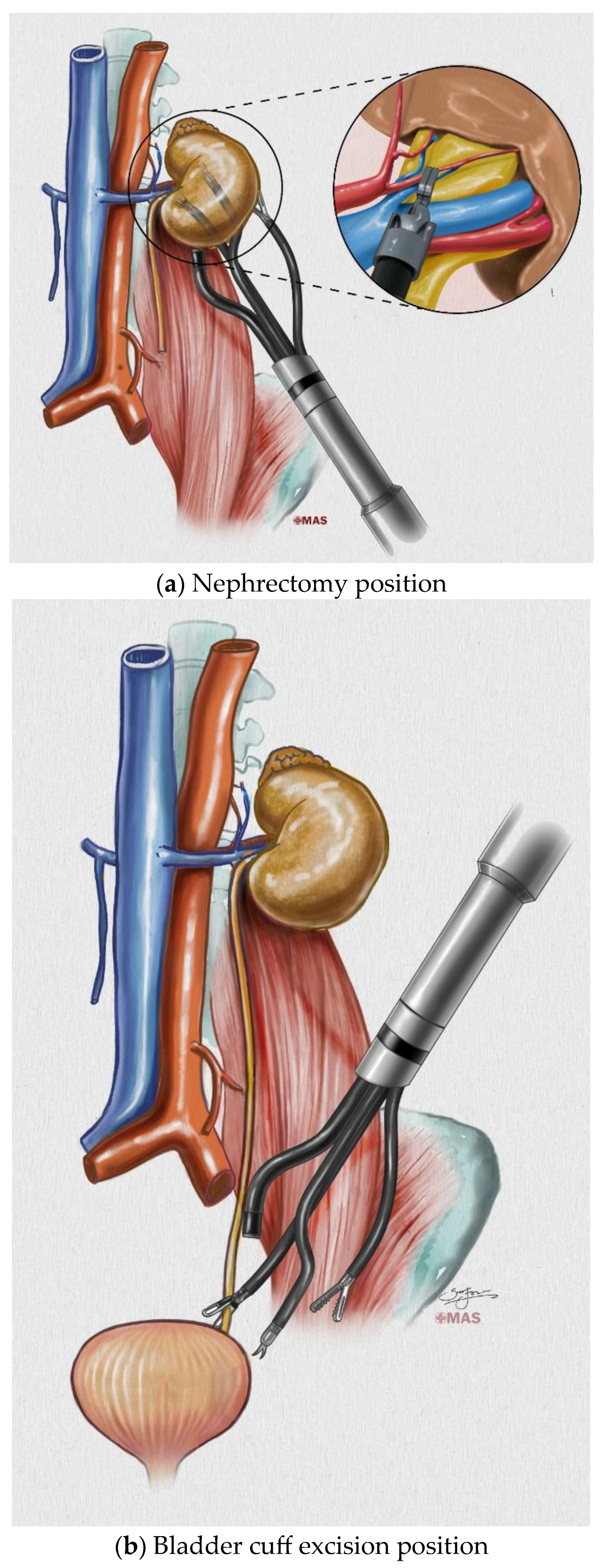 JCM | Free Full-Text | Retroperitoneal Single-Port Robot-Assisted  Nephroureterectomy with Bladder Cuff Excision: Initial Experience and  Description of the Technique