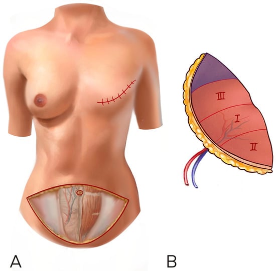 PDF) An Ideal Female Breast Shape in Balance with the Body Proportions of  Asians