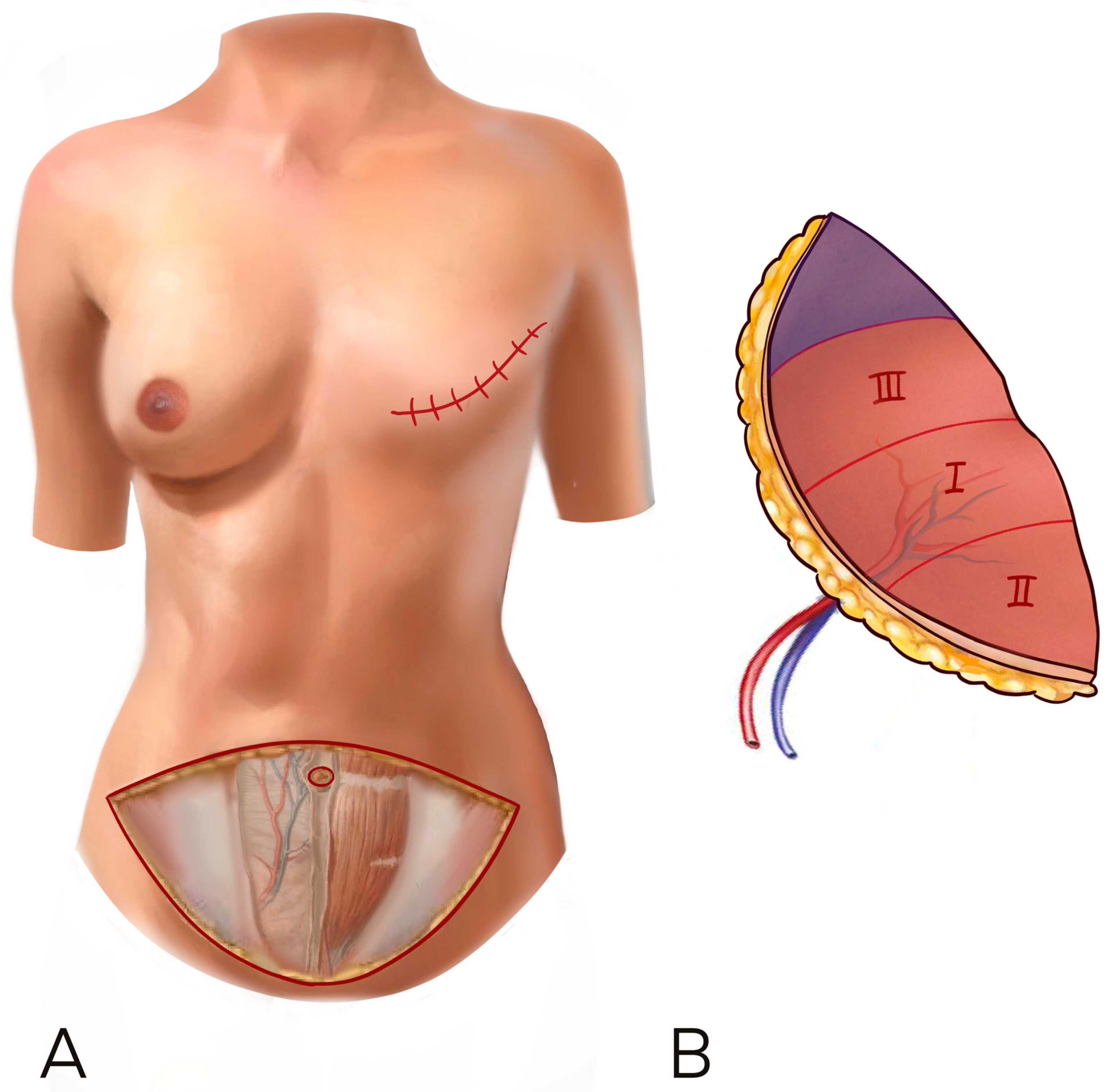 RBCP - Breast reconstruction with implant: creating a pocket with a reverse  serratus anterior muscle flap